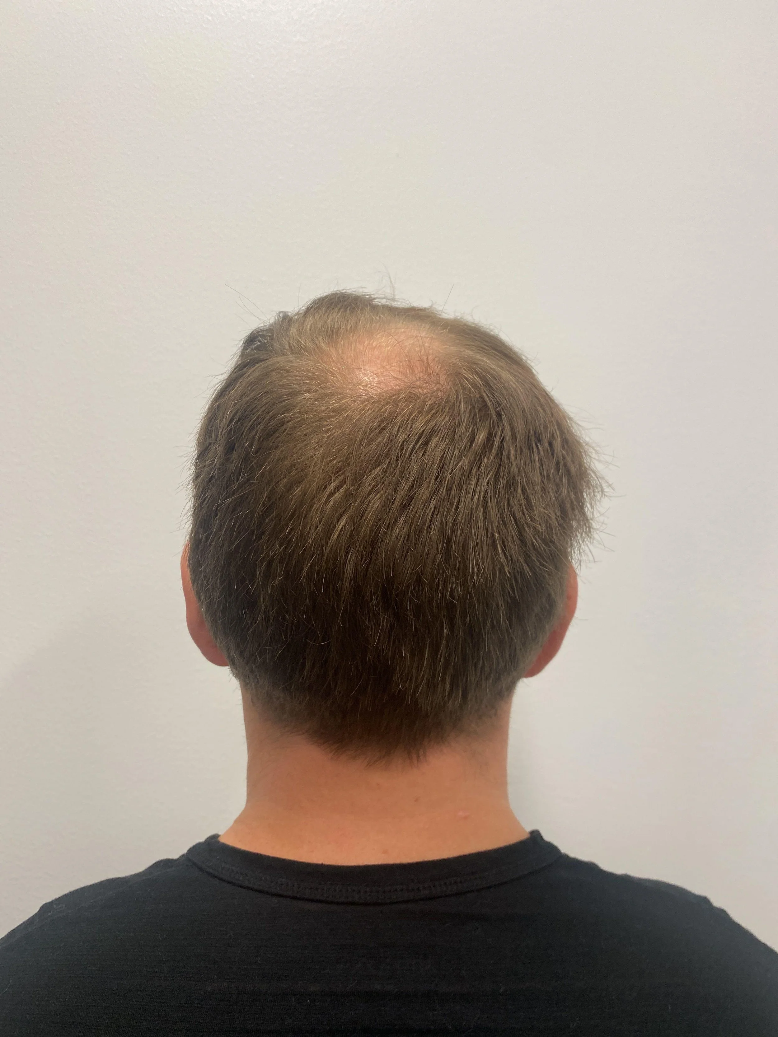 Donor area 11 months after first transplant