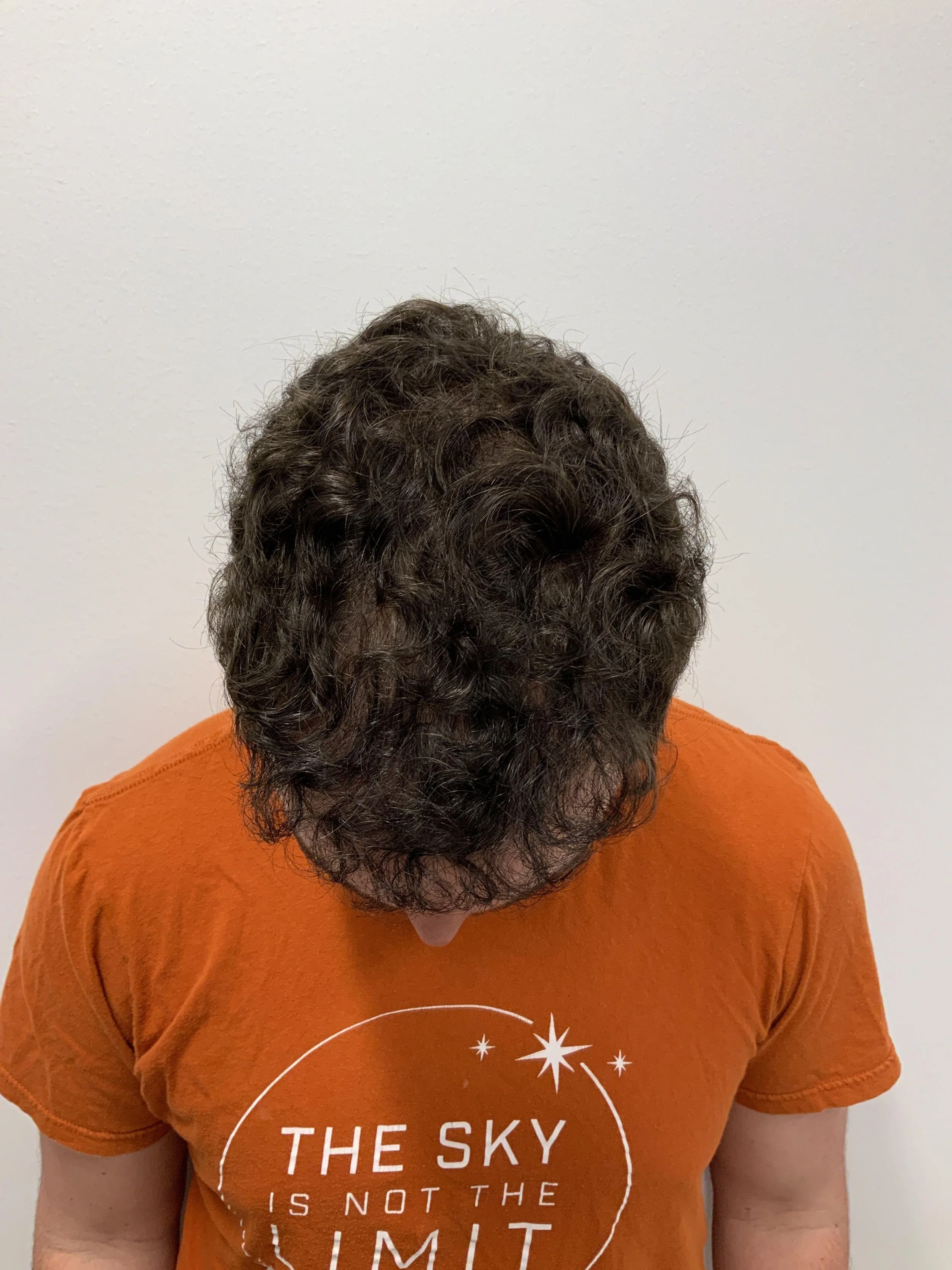 Top view 1 year post op