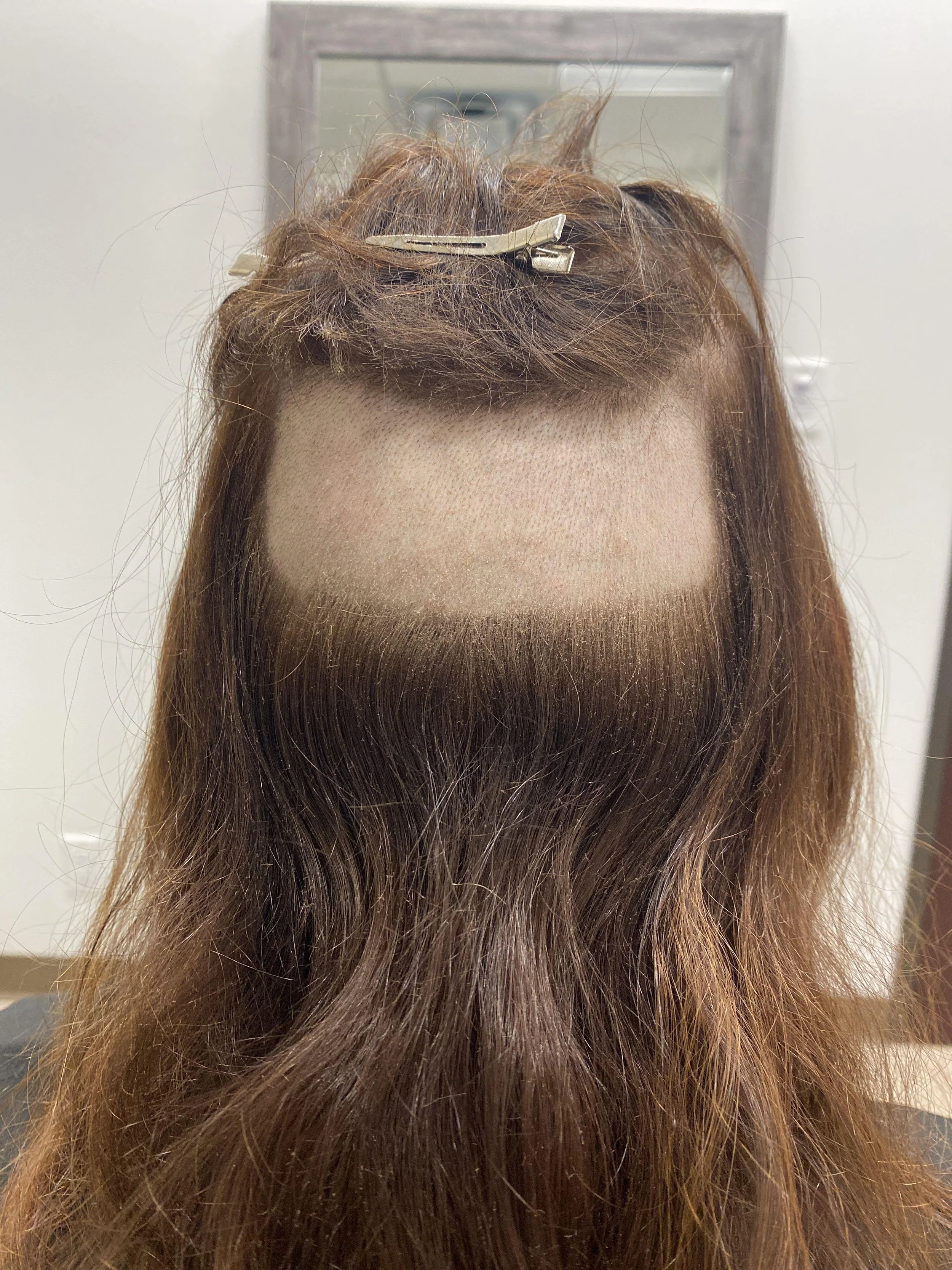 Donor area prepped for manual FUE harvesting. An under cut is done so that hair above the donor area falls over it and it is less noticeable as it grows in. 