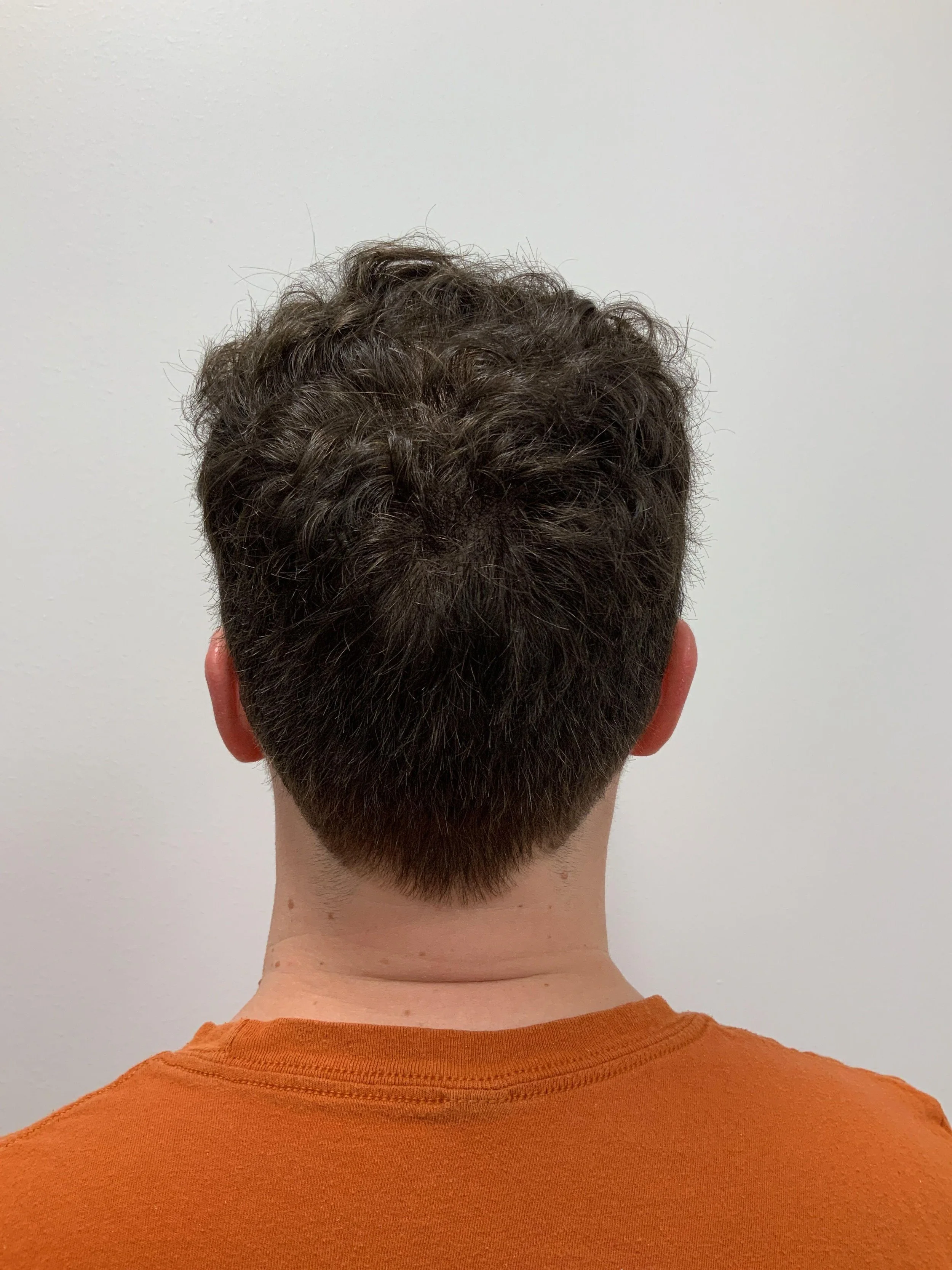 Donor area 1 year post op