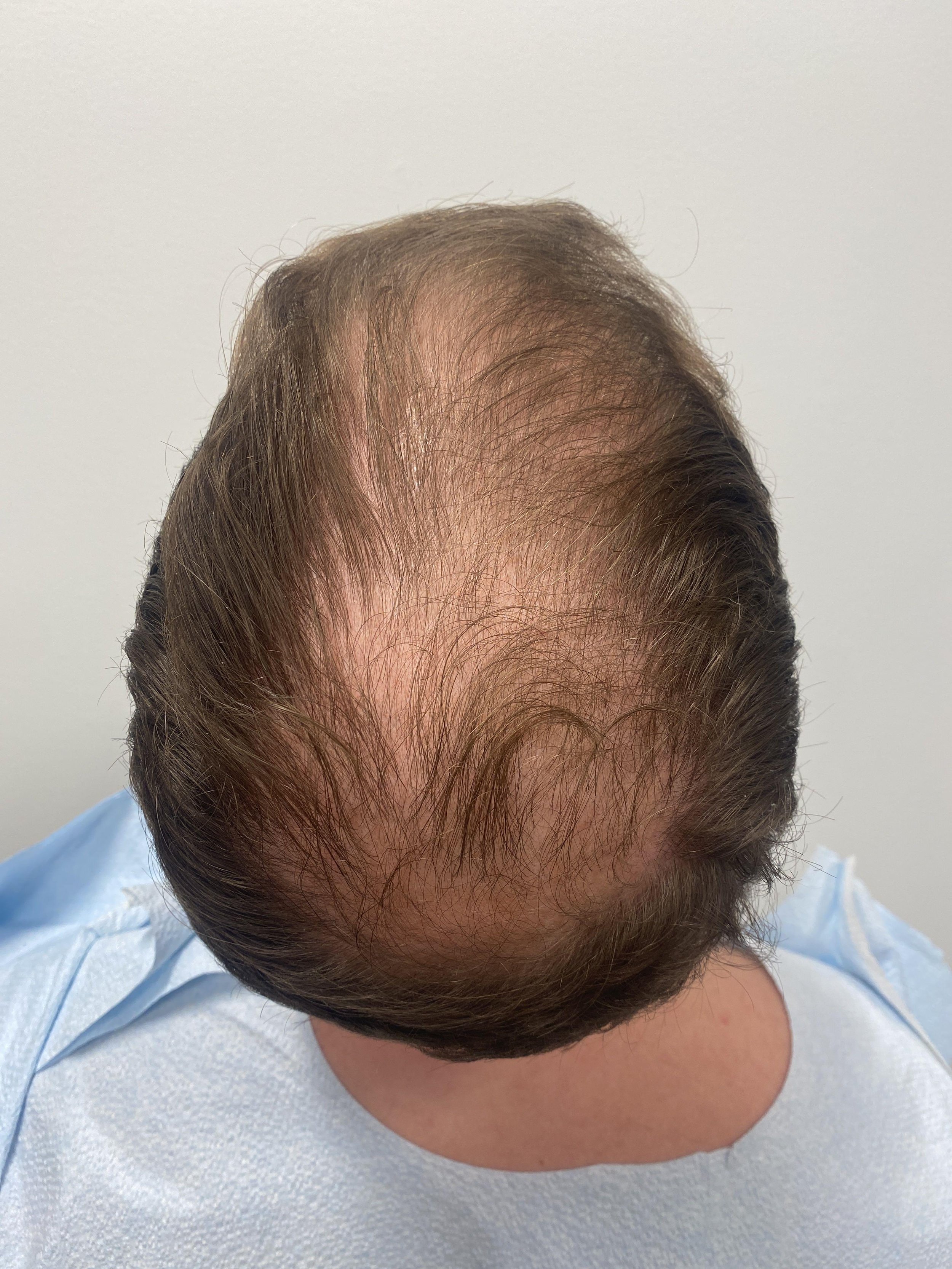 Crown view pre-op