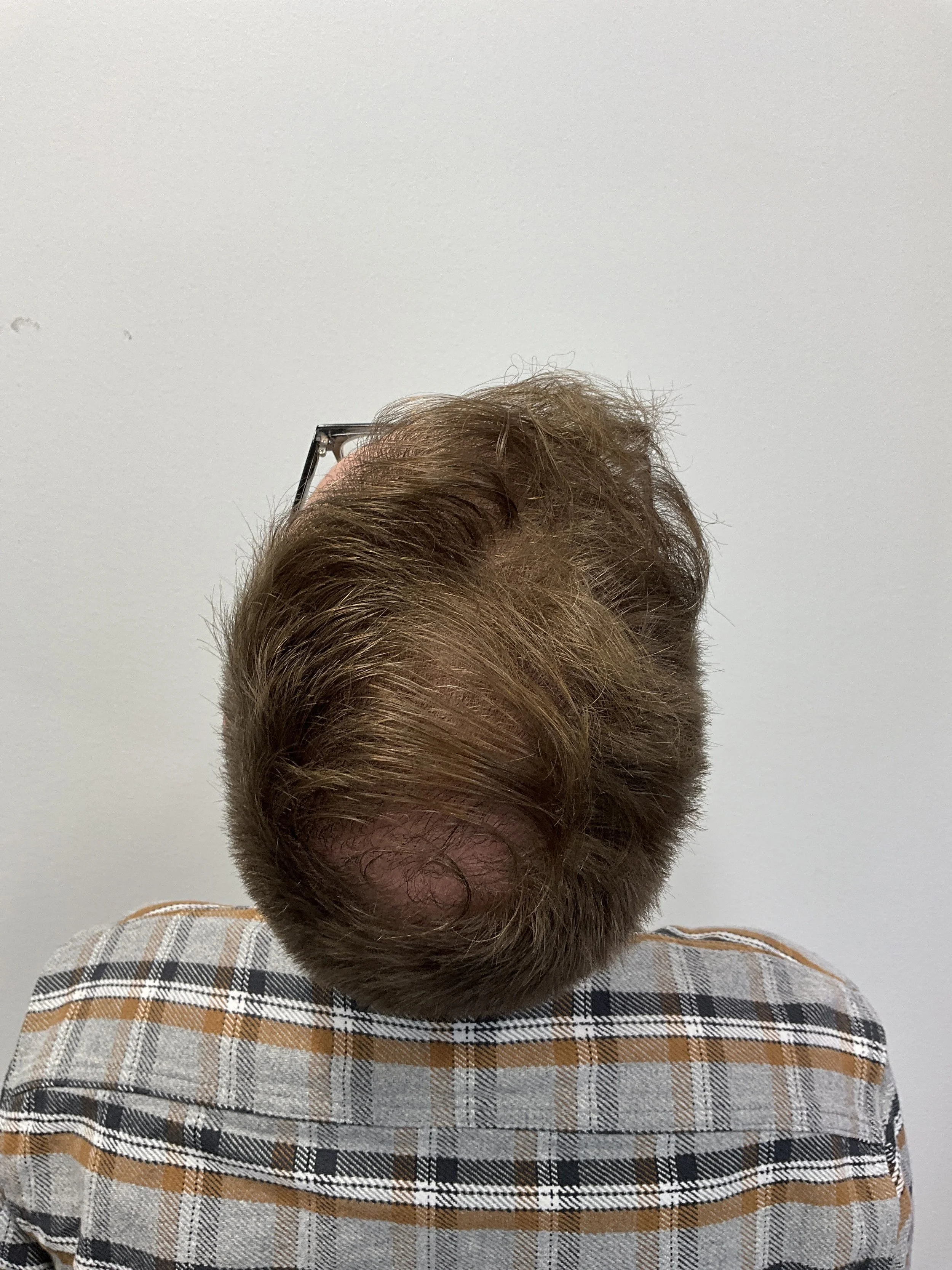 Crown view 12 months after second hair transplant to frontal scalp and crown region