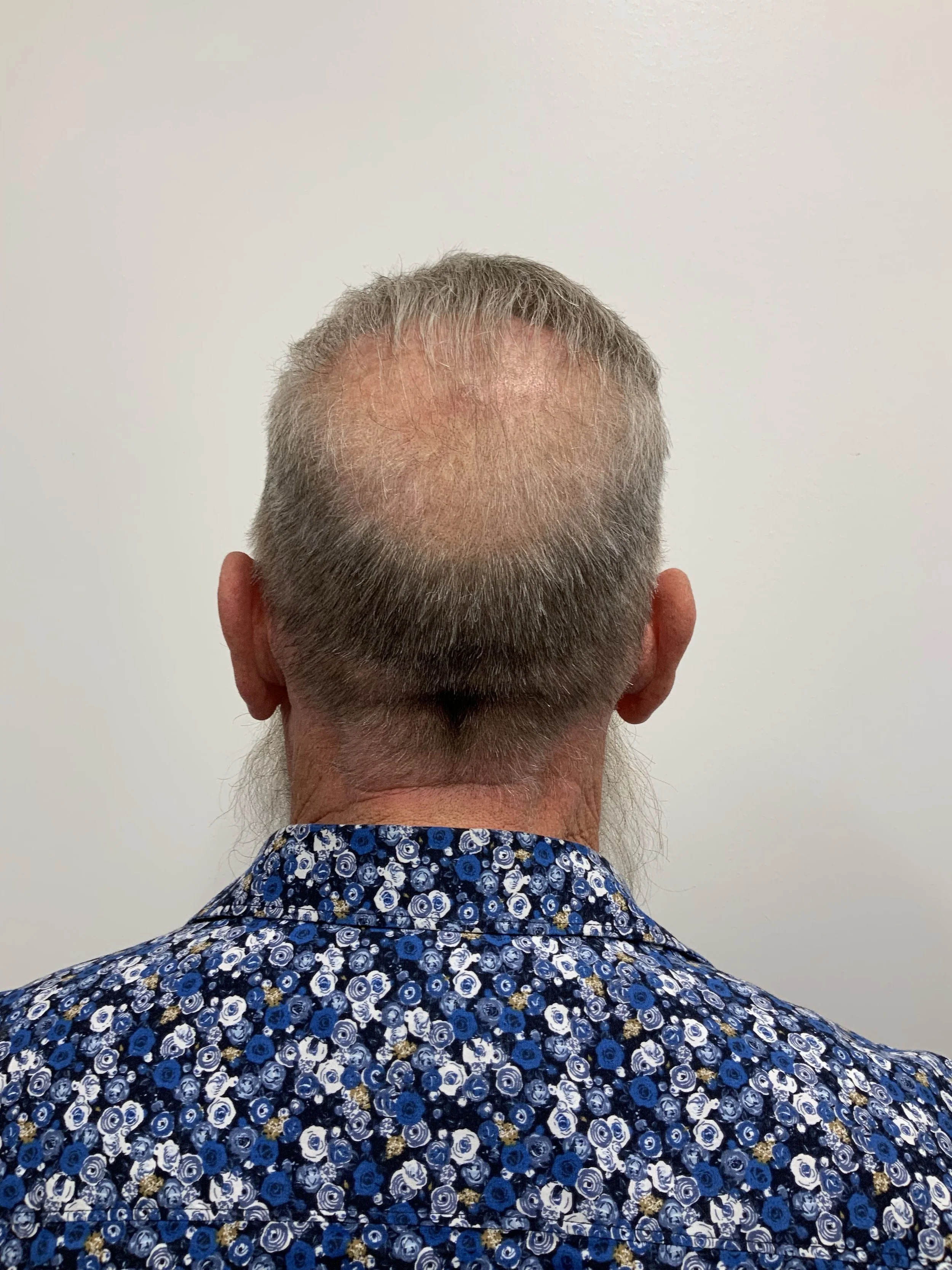 Donor area 9 months post op