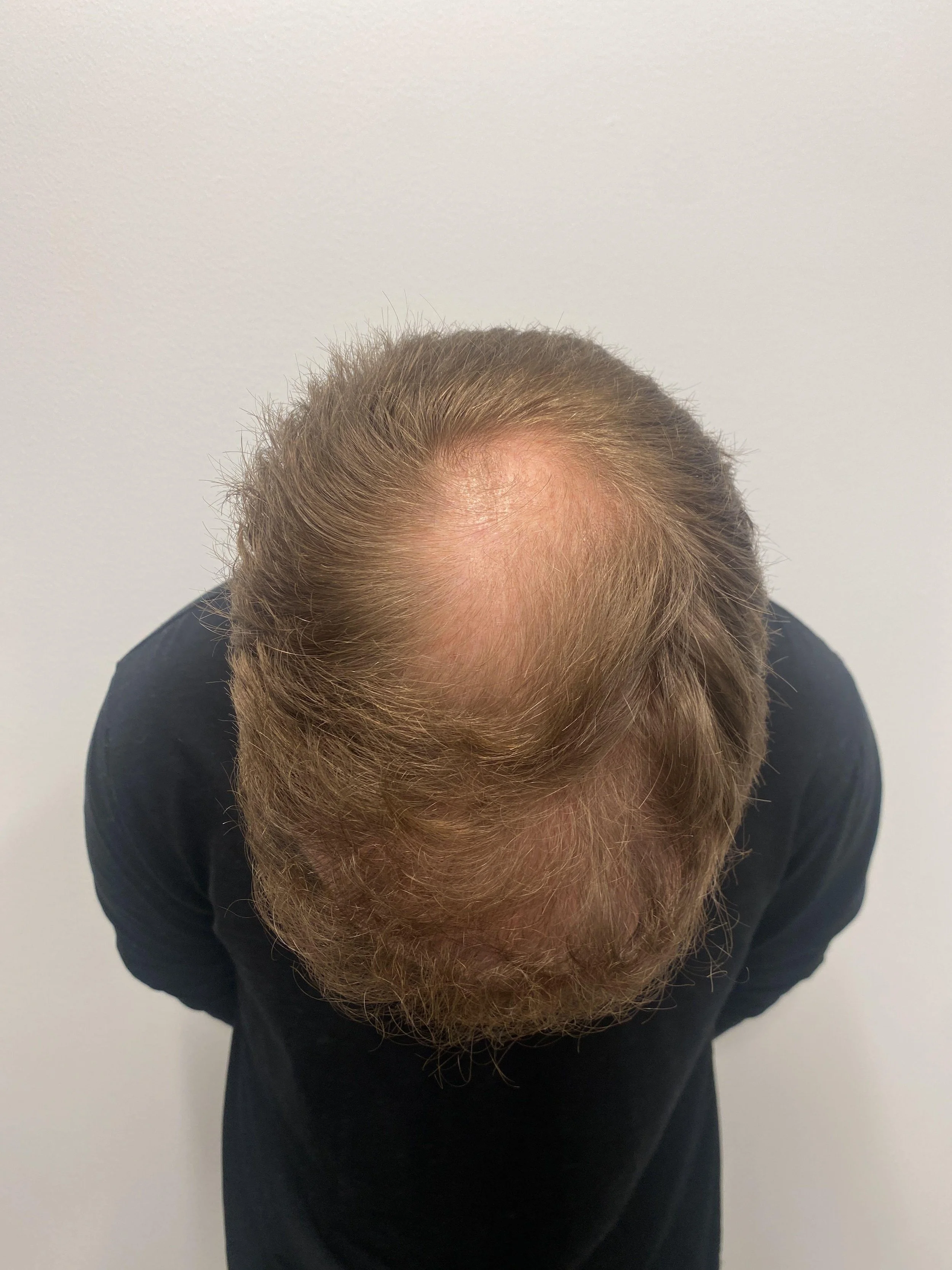 Top view 11 months after first transplant