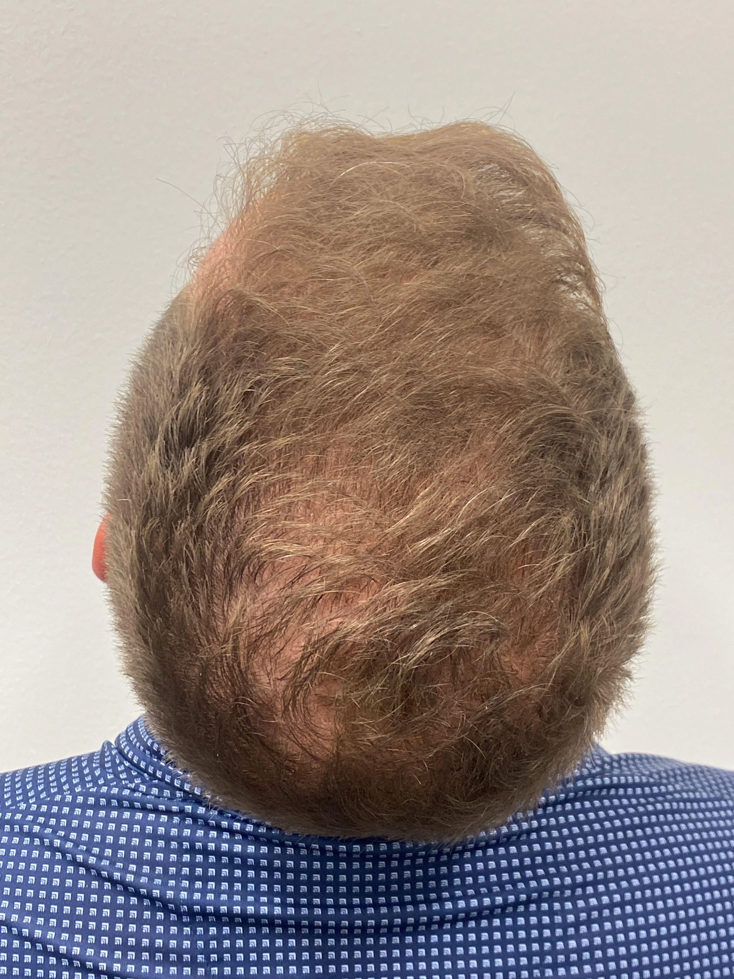 Crown view 10 months post op