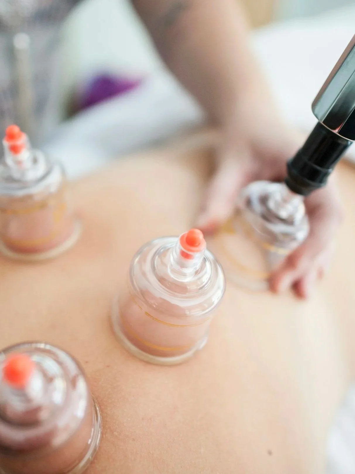 Cupping therapy
