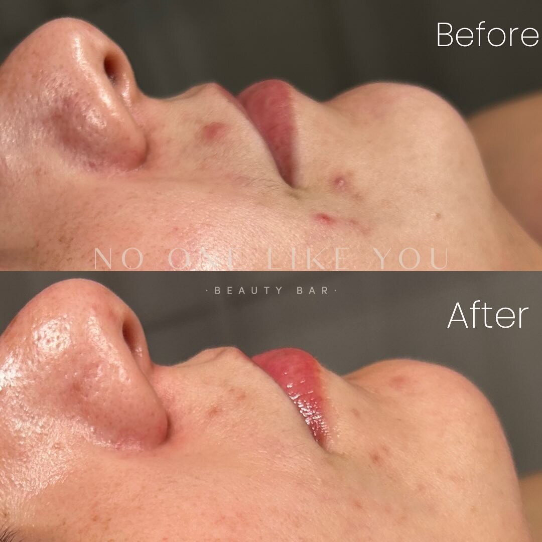 Acne bootcamp with @facerealityskincare 🤍🥹

This was just ONE peel &amp; home care 🙏🏼🙏🏼😩 my beautiful client saw a difference immediately.  We are still working on her version of glass skin but these results are so stunning I had to post ✨🤍

