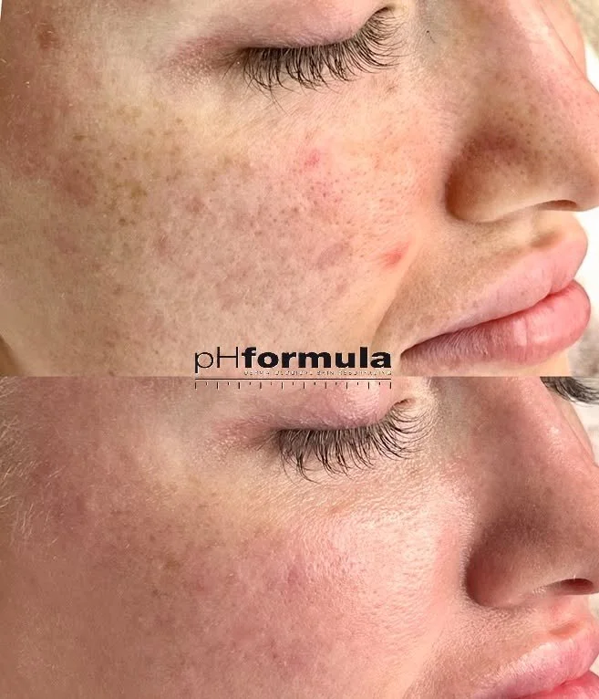 Me hoidamme paljon erilaisia ihoja.

T&auml;ss&auml; kuvasarjassa asiakkaalleni tehty pHformulan 3-sarjan pinnoitushoitosarja, joka todella antaa n&auml;kyvi&auml;, tehokkaita ja pitk&auml;kestoisia tuloksia, ilman toipumisaikoja🩷

Ihon pinnoitushoi