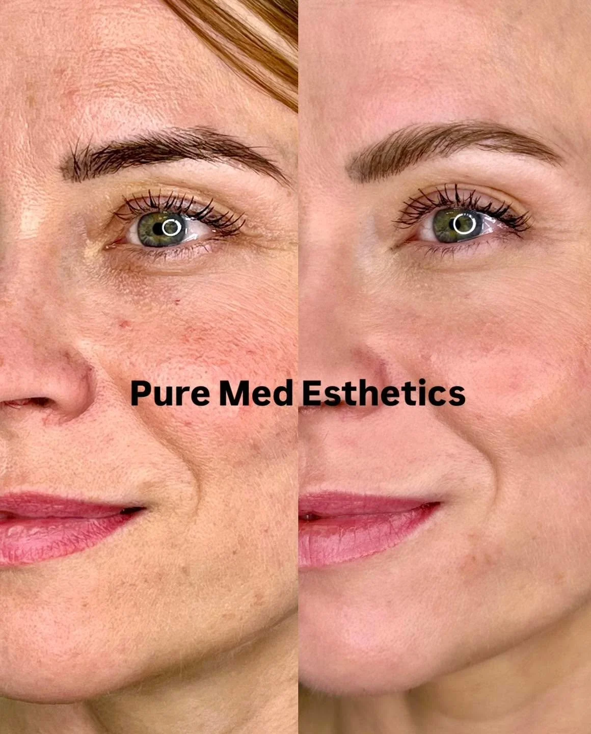 One treatment - incredible results ✨ 

Kes&auml;kuussa tehty Tience-hoito sai n&auml;yttelij&auml;, tanssija Tiia Elgin ihon uudistumaan sis&auml;lt&auml;p&auml;in. 

Suositussa 2 ampullin hoidossa toinen ampulli annosteltiin silm&auml;nalusiholle ja