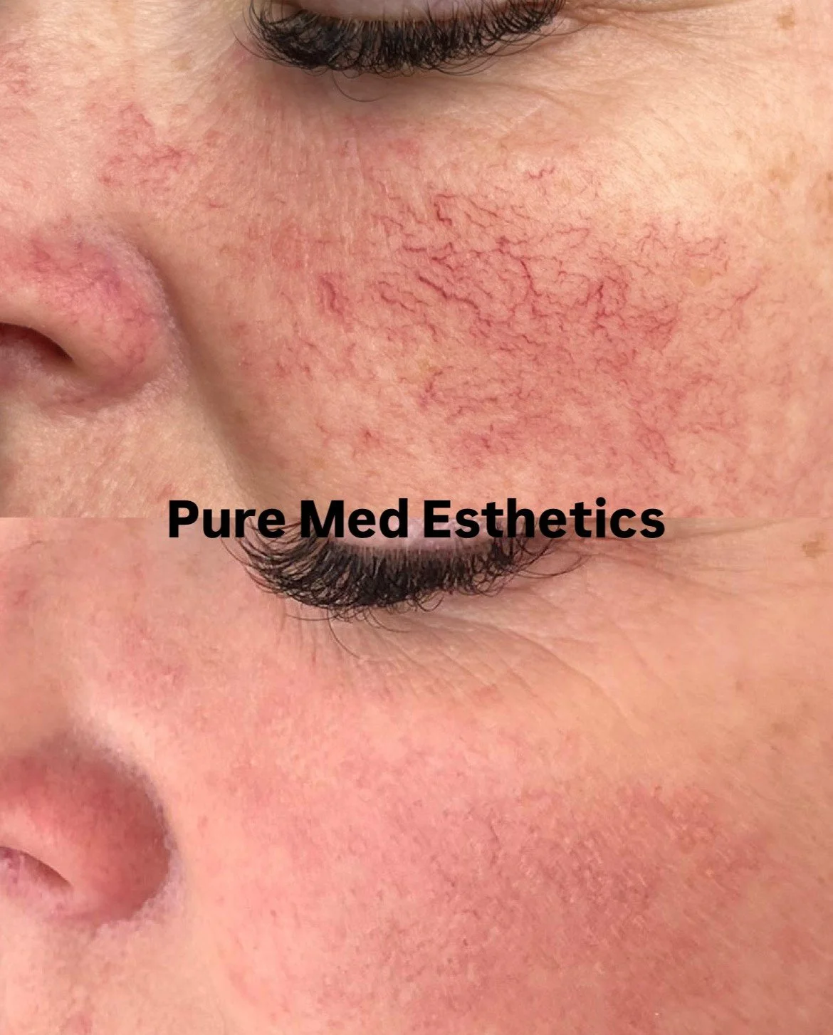 Onko sinulla h&auml;iritsevi&auml; pintaverisuonia kasvoissa/s&auml;&auml;riss&auml; tai muualla vartalon alueella? 

Radiofrekvenssin (RF) tuottama l&auml;mp&ouml;energia h&auml;ivytt&auml;&auml; pintaverisuonet turvallisesti ja tehokkaasti vaurioit