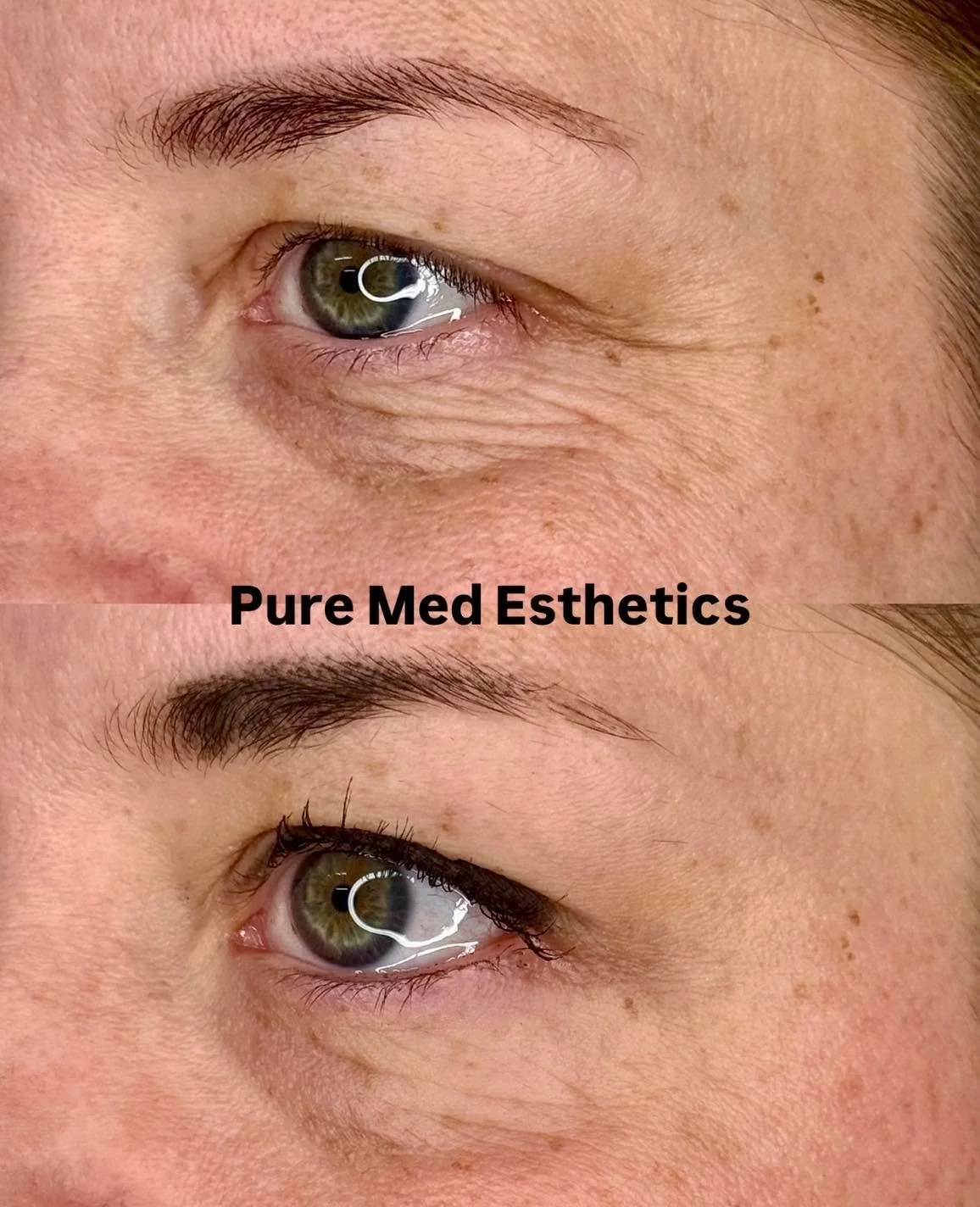 Silm&auml;nymp&auml;rysihon hoito raikastaa usein huomattavasti yleisilmett&auml;. 
Tarjoamme useita tehokkaita ja turvallisia vaihtoehtoja  juonteisiin, turvotukseen, kuivuuteen, tai tummuuteen ohuella silm&auml;nymp&auml;rysiholla✨

Aloita varaamal