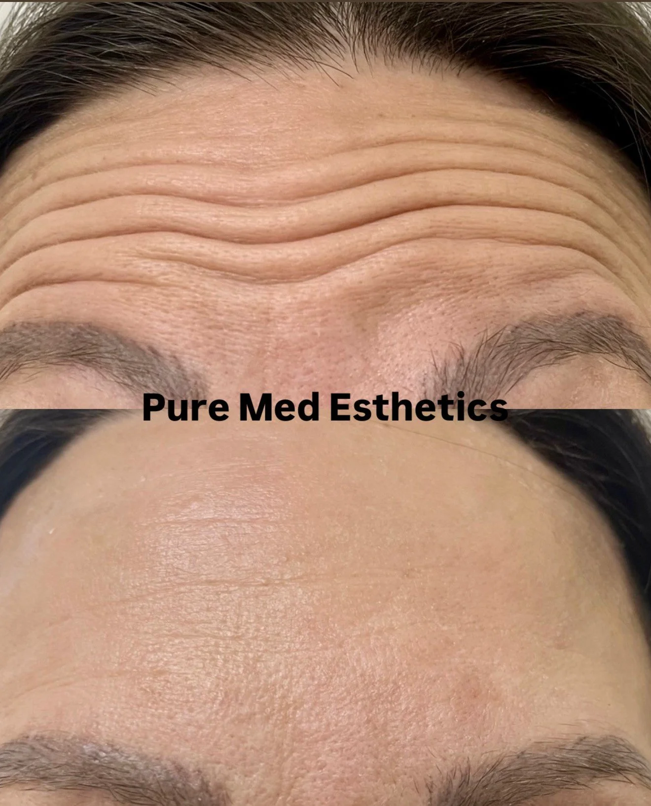 Klinikan suosituin hoito on esteettinen botuliinihoito.

Mihin hoidon suosio perustuu? 😍
Hoidon suosio perustuu varmasti sen tehokkuuteen yhdistettyn&auml; turvallisuuteen ja nopeisiin hoitotuloksiin. Muutama p&auml;iv&auml; hoidosta hoidettu lihas 