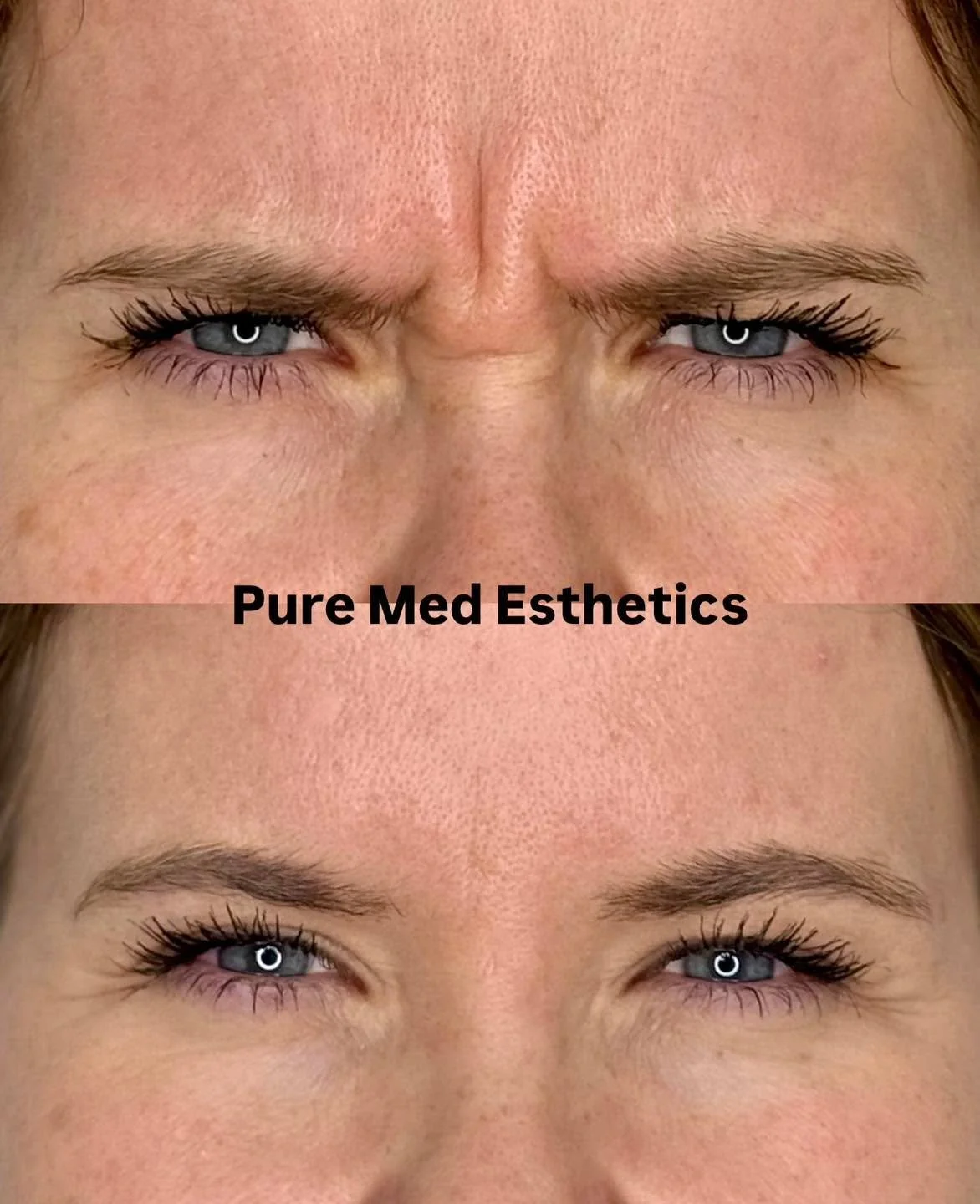 Sibeliusrypyn hoito botuliinilla✨
Ennen ja j&auml;lkeen kuvien v&auml;liss&auml; aikaa 2 viikkoa. 

Hoidon teko vie aikaa muutaman minuutin ja varsinaista palautumisaikaa ei ole. 
Muutama p&auml;iv&auml; hoidosta hoidettu lihas alkaa rentoutumaan ja 