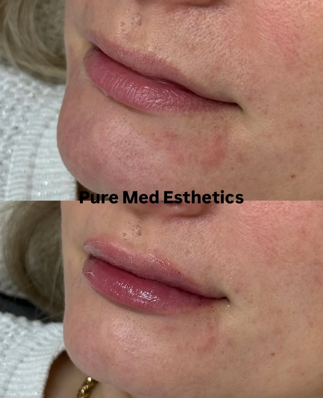 Ep&auml;symmetrian korjaaminen yl&auml;huulessa ja luonnollista t&auml;ytel&auml;isyytt&auml;. 
N&auml;m&auml; olivat asiakkaan toiveet ensimm&auml;isest&auml; kertaa huulten t&auml;yteainehoitoon tullessa.

Huulten t&auml;yteainehoidon ei tarvitse t