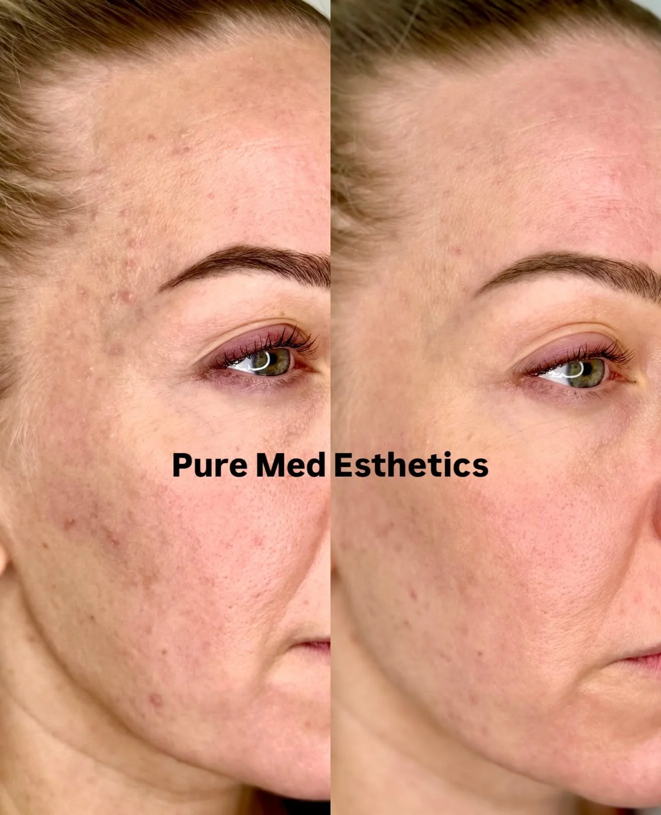 Power of Tience ✨

J&auml;lleen kerran n&auml;m&auml; kuvat osoittavat, ett&auml; Tience pit&auml;&auml; lupauksensa ihon nuorennushoitona. Asiakkaalle tehtiin lokakuussa -25 kertaalleen 2 ampullin Tience-hoito silm&auml;nalusiholle ja kasvoille.

Ta