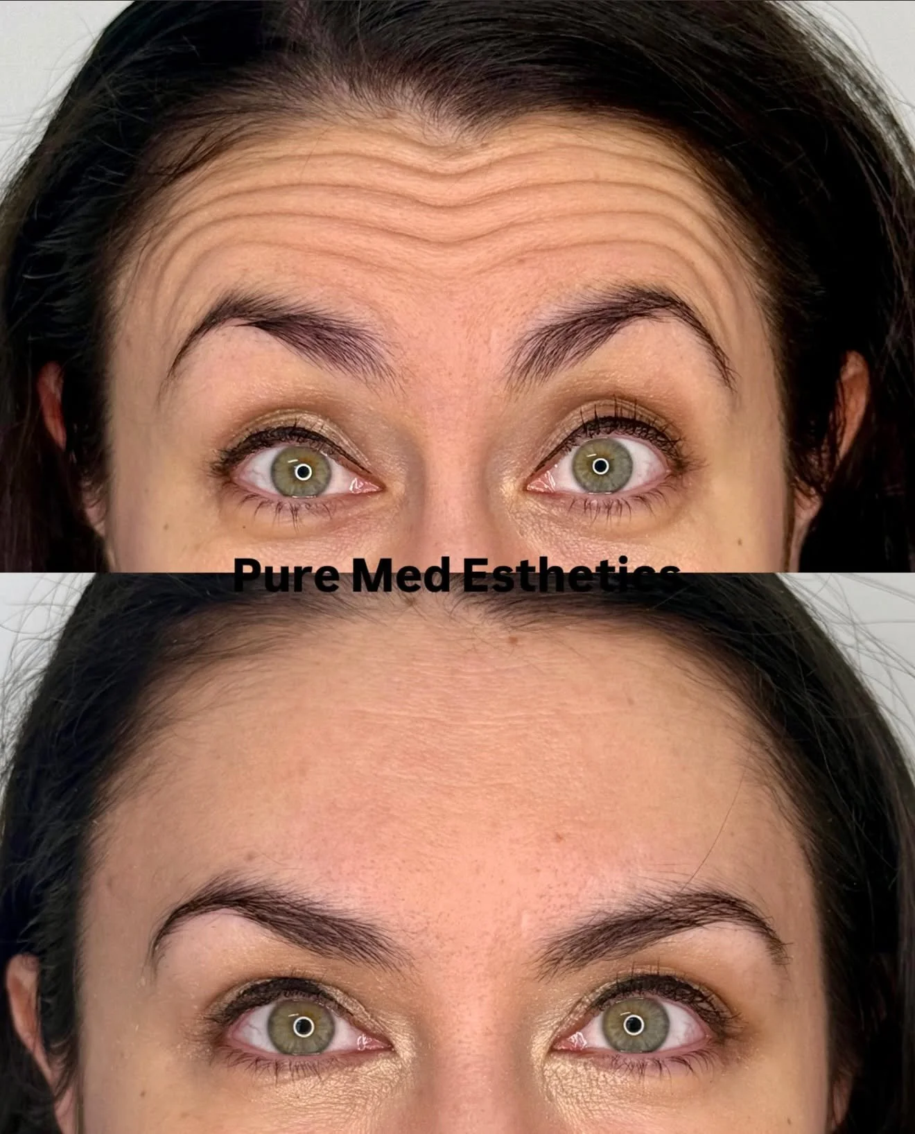 Botox-hoidot ovat maailmanlaajuisesti suosituin esteettinen hoito eik&auml; ihme. Esteettinen botuliinihoito on turvallisin, tehokkain ja nopein keino hoitaa ja ennaltaehk&auml;ist&auml; yl&auml;kasvojen ik&auml;&auml;ntymismuutoksia. 

Toteutamme vi