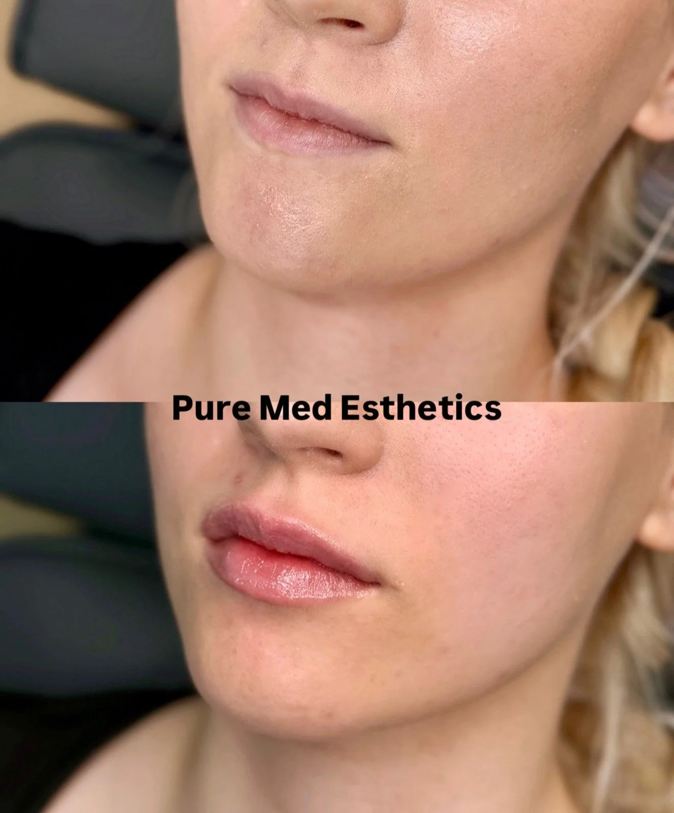 Asiakkaan ensimm&auml;inen huulten t&auml;yteainehoito. 
Toiveena t&auml;ytel&auml;isemm&auml;t huulet👄

Hoidon hinta: 319&euro; 

Jos kaipaat luonnollisia, tyylikk&auml;it&auml; lopputuloksia, me olemme oikea paikka! 
Tarjoamme aina halutessasi sai