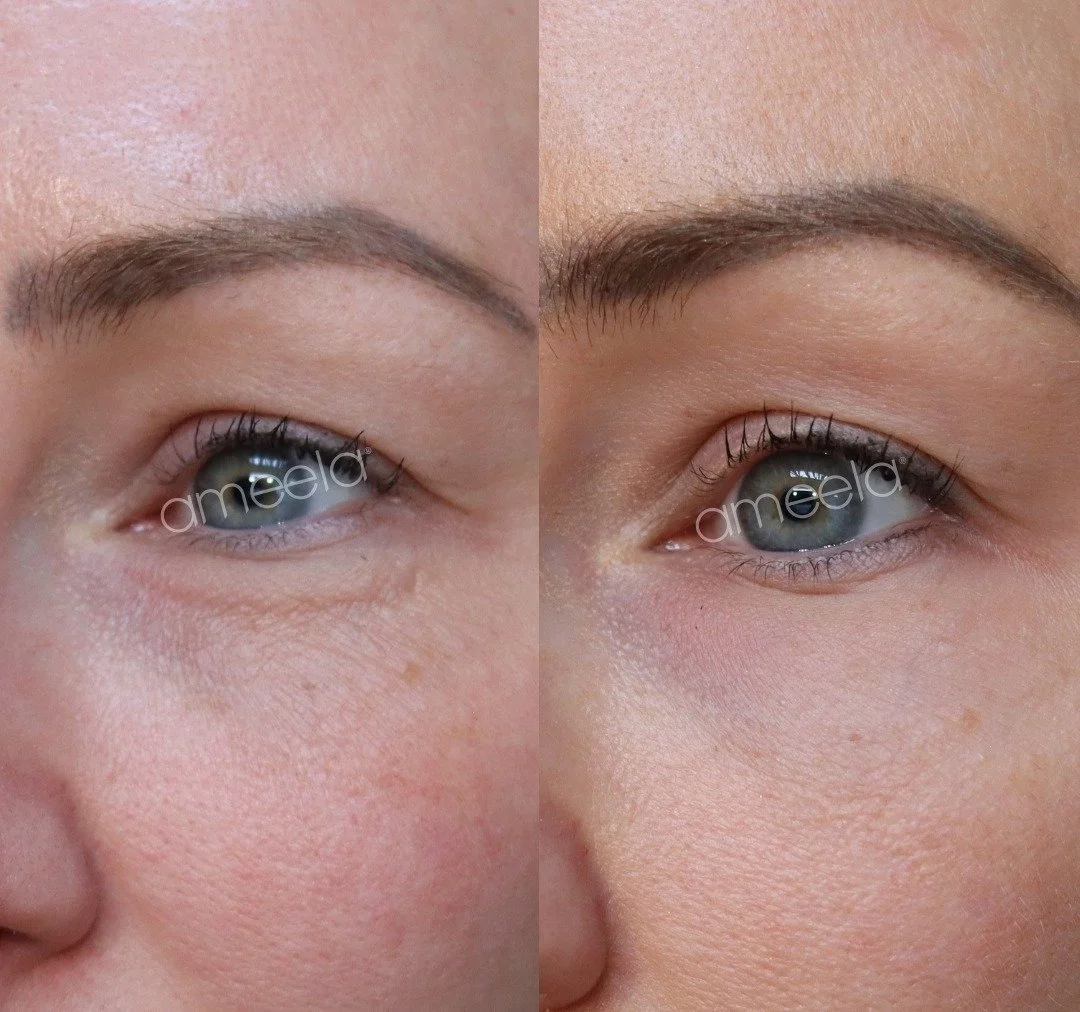 Maaliskuun kampanjahoito, polynukleotidit, on ihoa uudistava hoito, josta puhutaan nyt kaikkialla &ndash; &ldquo;lohen sperma-hoitona&rdquo;😍

Polynukleotidit toimivat ihossa biostimulantteina eli korjaavat ihoa sis&auml;lt&auml;p&auml;in solutasoll