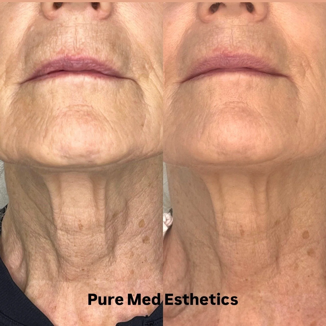 Mit&auml; jos iho voisi nuorentaa itse itsens&auml;? 😍
Se todella on mahdollista. Yli 15 vuoden tutkimusty&ouml;n j&auml;lkeen, suomalaiset solubiologit l&ouml;ysiv&auml;t keinon ihon uusiutumiseen.

T&auml;ss&auml; kuvassa hoidettu yhden kerran asi