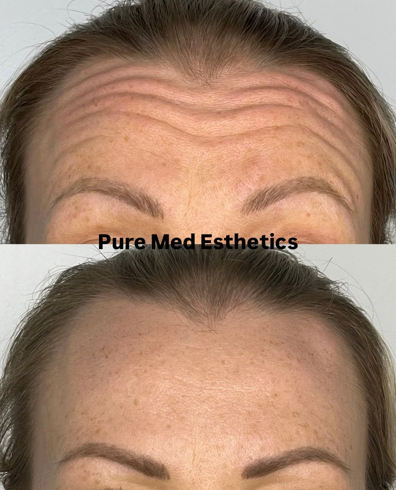 Botox-hoidot ovat maailman suosituin esteettinen hoito ja my&ouml;s meid&auml;n klinikan suosituin hoito. 

Hoidot ovat tehokas, nopea ja turvallinen keino hoitaa ja ennaltaehk&auml;ist&auml; yl&auml;kasvojen ik&auml;&auml;ntymismuutoksia.

Tarjoamme