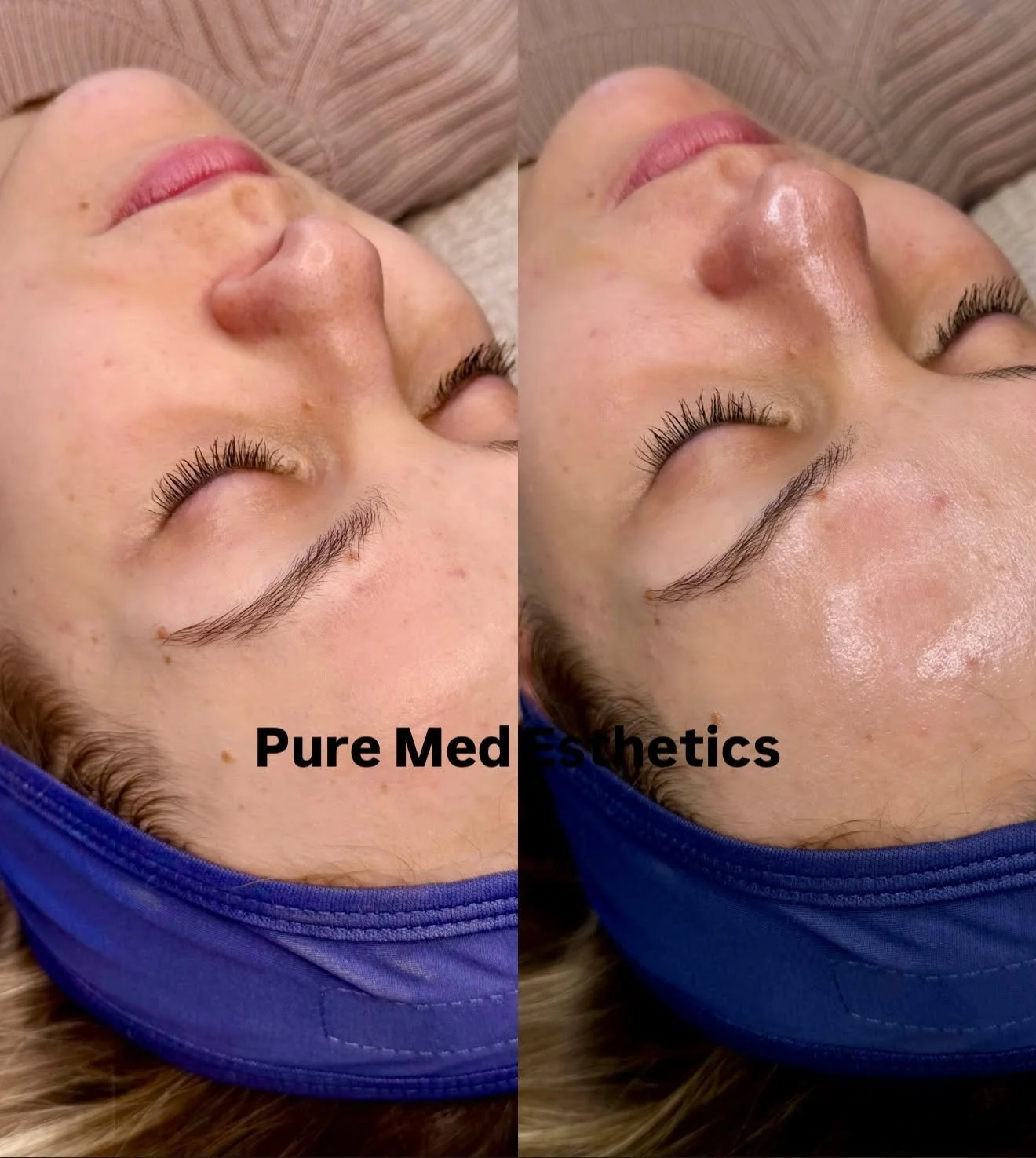 Hydrafacial -kasvohoidon j&auml;lkeinen GLOW✨

Hydrafacial on maailmaa valloittanut laitehoito, jossa yhdistyy ihon puhdistus, kuorinta, ihohuokosten tyhjennys sek&auml; ihon tarpeiden mukainen tehoaineiden imeytys. Lopputuloksena on raikas, kosteute