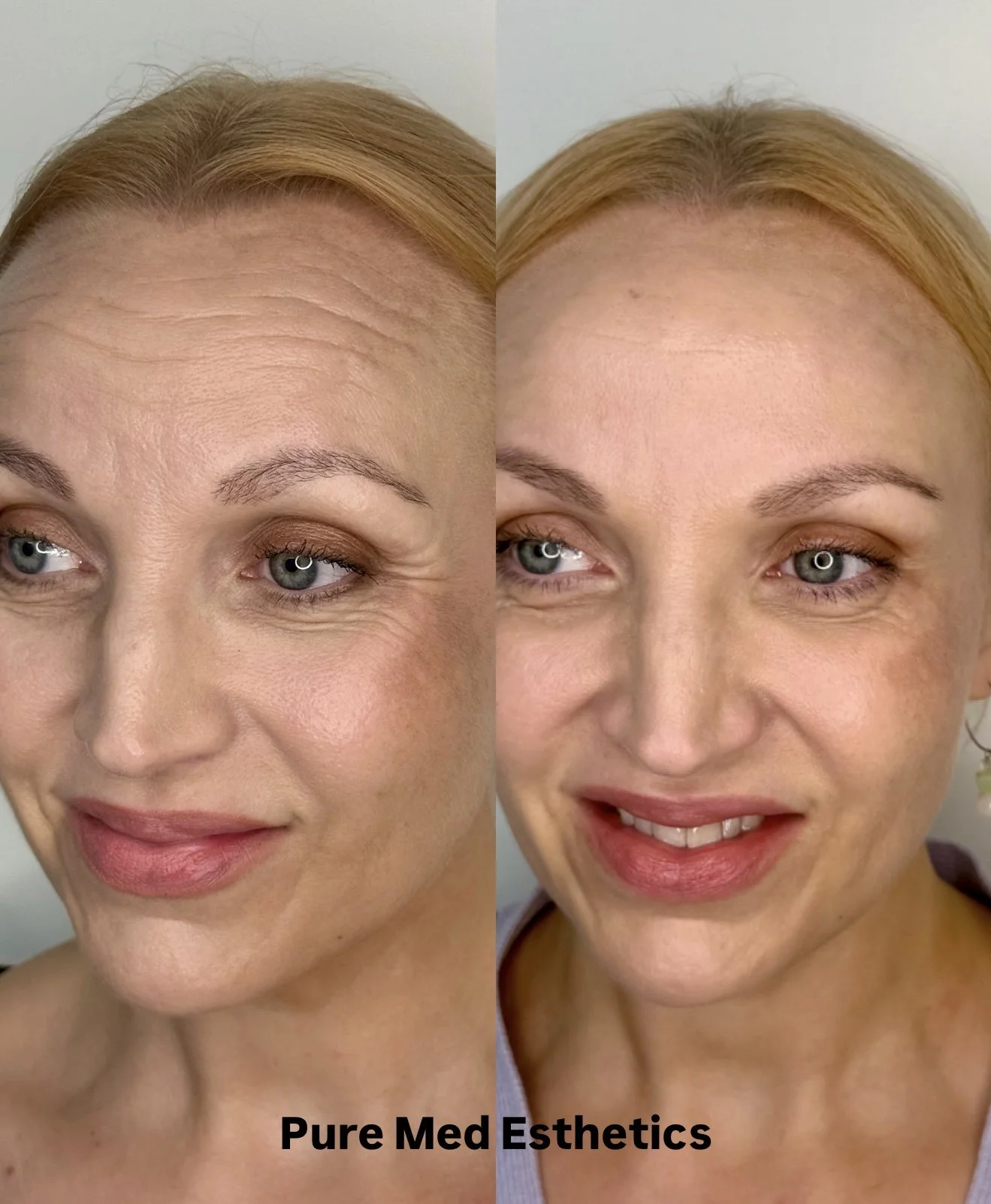 botox ennen ja jälkeen