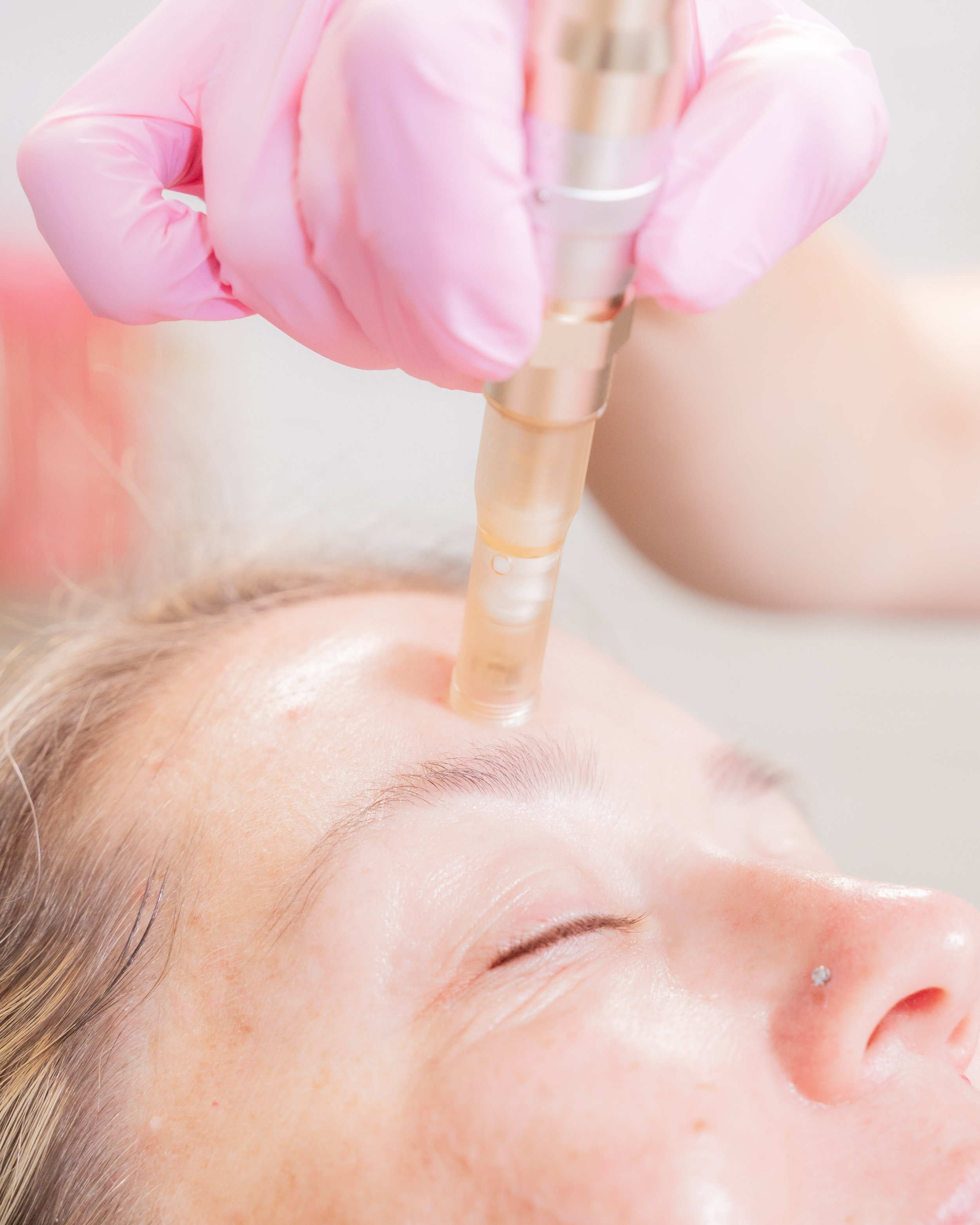 Medspa in Pleasanton, CA, 94566 | Microneedling Near Me