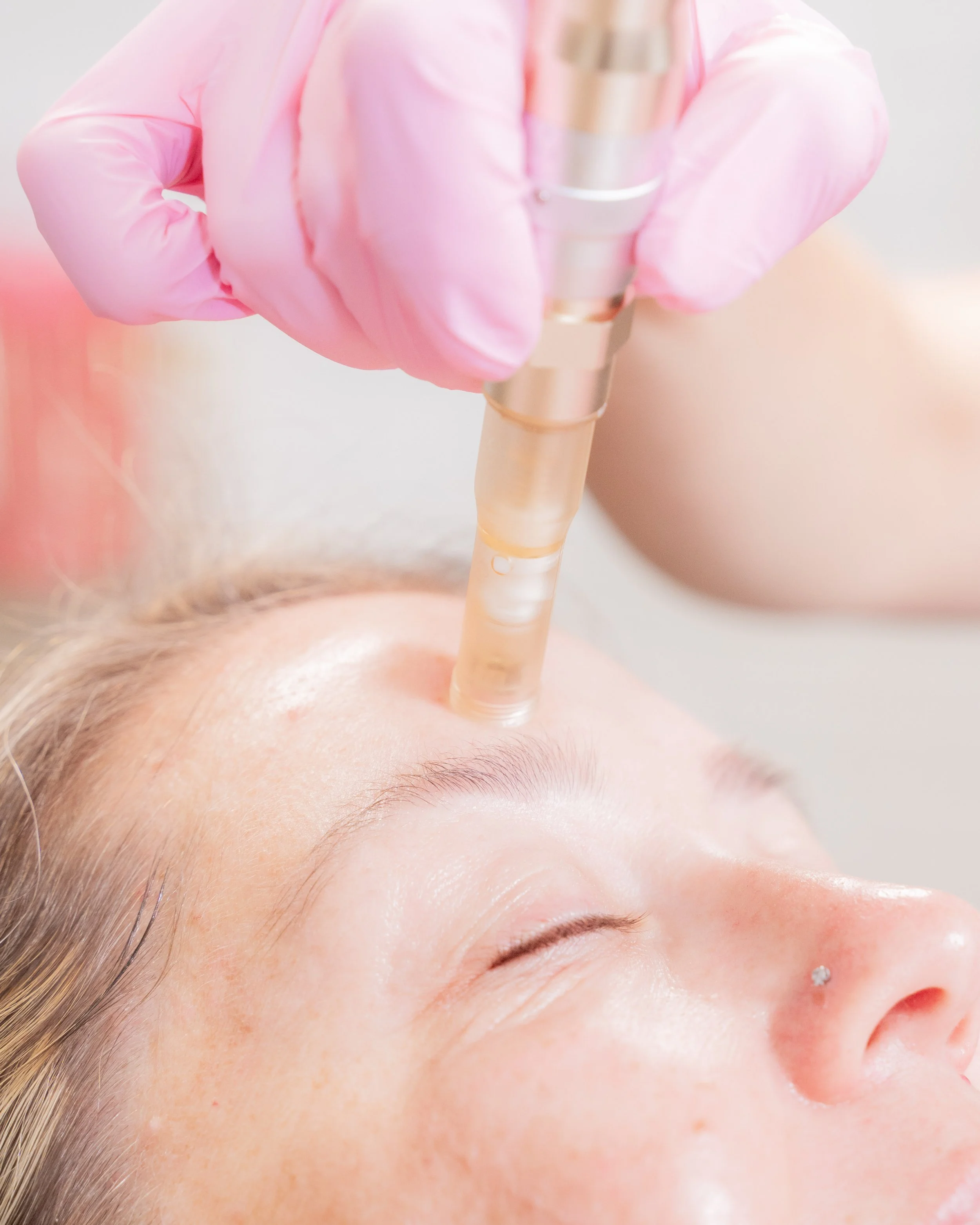 Medspa in Pleasanton, CA, 94566  Regenerative Microneedling Near Me