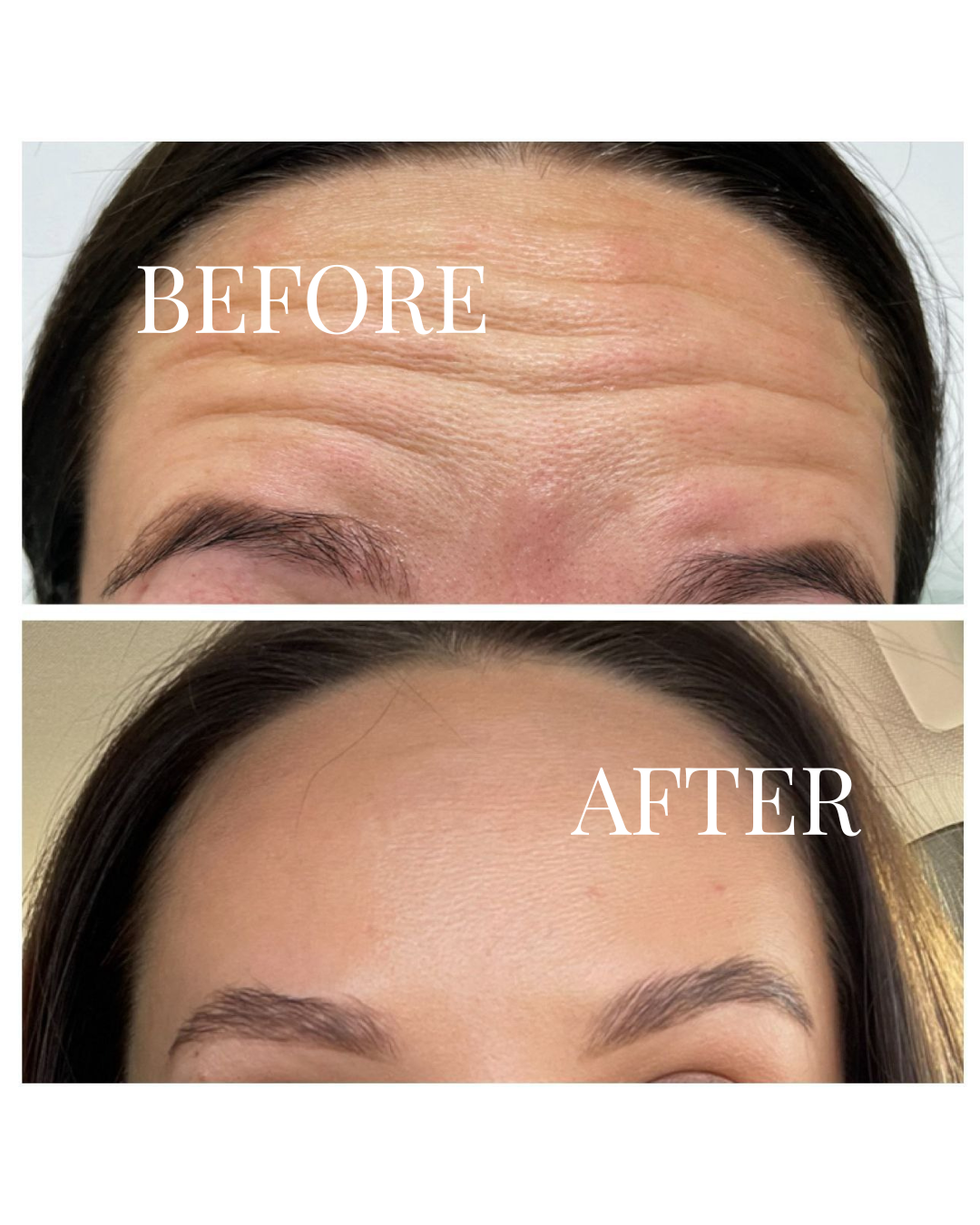 Side-by-side comparison of a person's forehead before and after skincare treatment, showing reduced wrinkles and smoother skin.