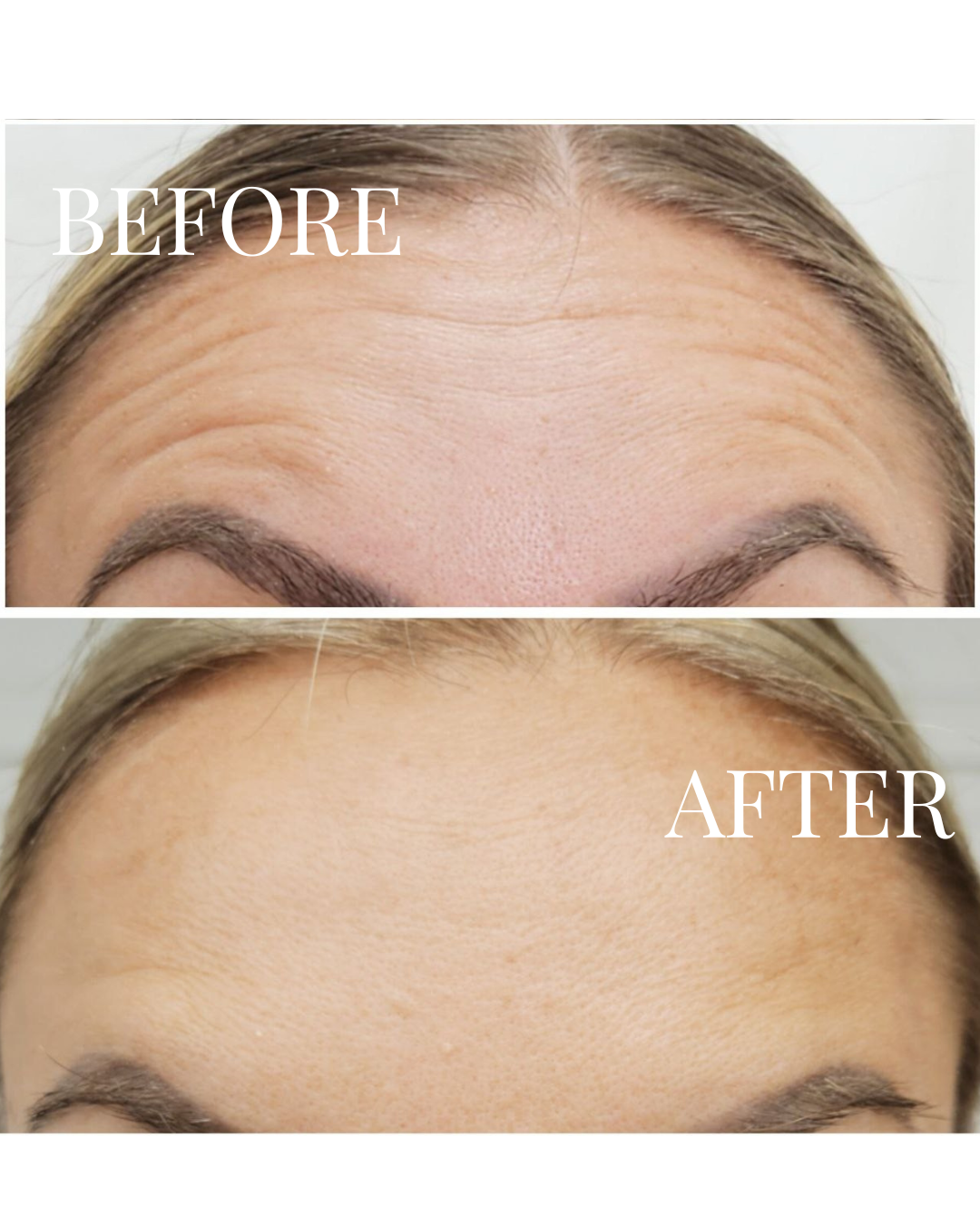 Comparison of a person's forehead before and after skin treatment, showing reduced wrinkles and smoother skin.