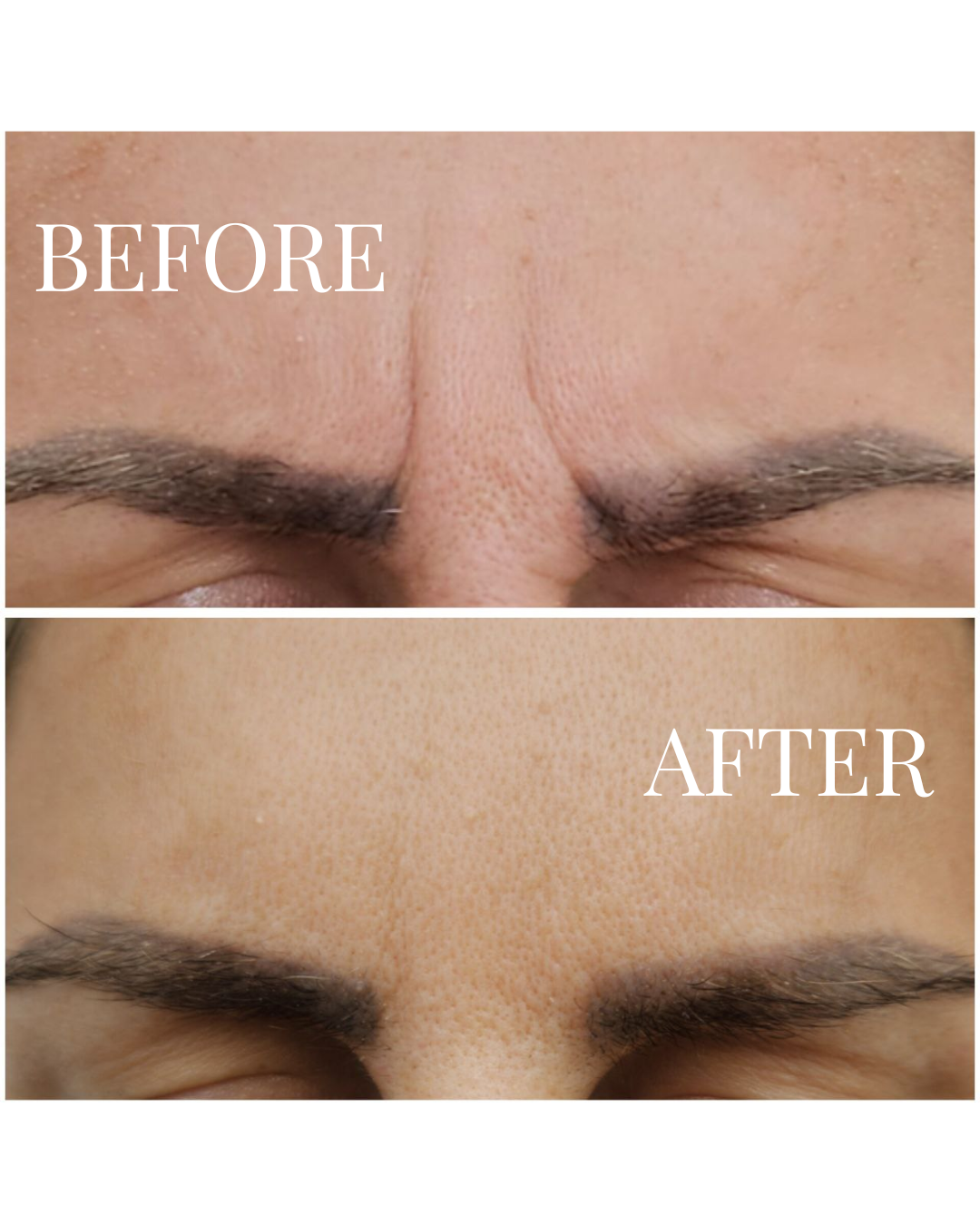 Close-up of a person's forehead shown in a before-and-after comparison. The "before" image shows visible wrinkles and skin texture, while the "after" image shows smoother, less wrinkled skin after treatment or skincare.