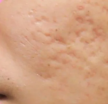 Face Mild Boxcar | Naperville, IL