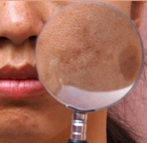 Fix uneven skin texture at Levore Aesthetics in Naperville, IL