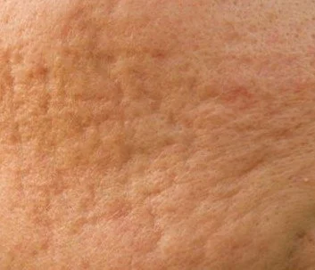 Rolling-Scars-Sample-Image-For-Reference