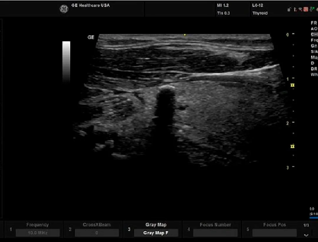 Virtual Convex (modo convexo virtual).jpg