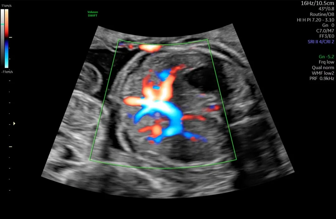 Hígado con HD-Flow™.jpg