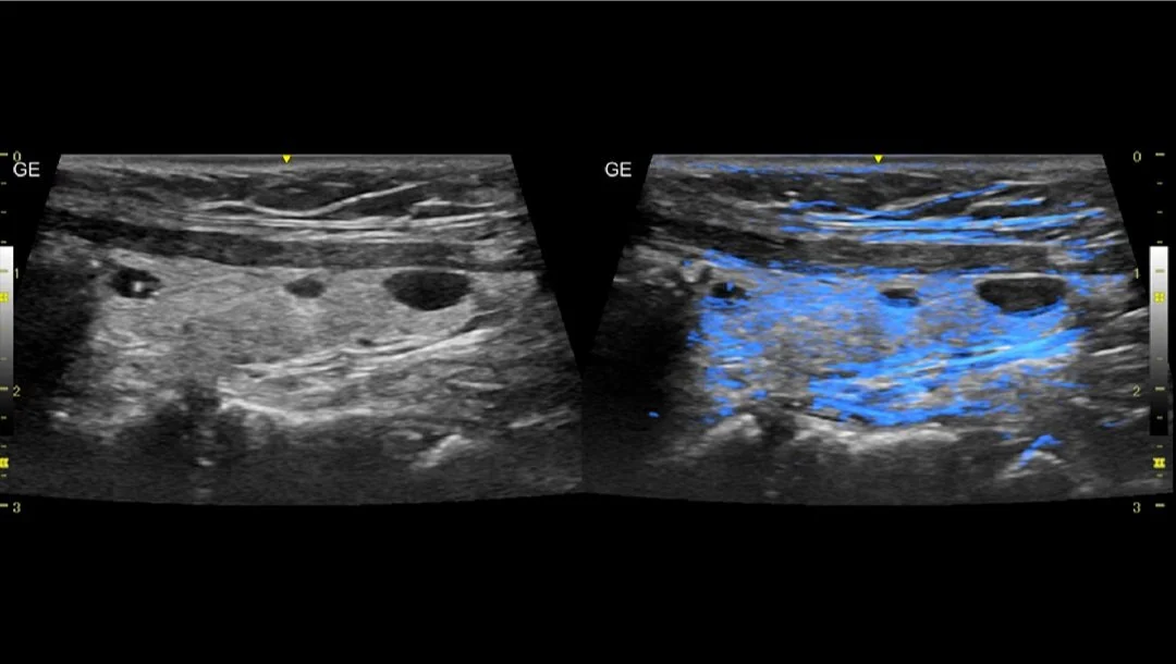 Tiroides con Virtual Convex y Follow-Up Fusion.jpg