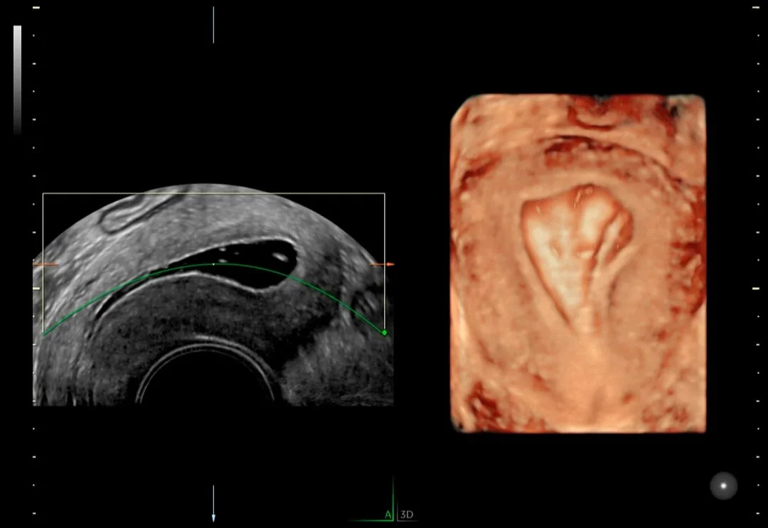 Sonohisterografía con️ HDLive™.jpg