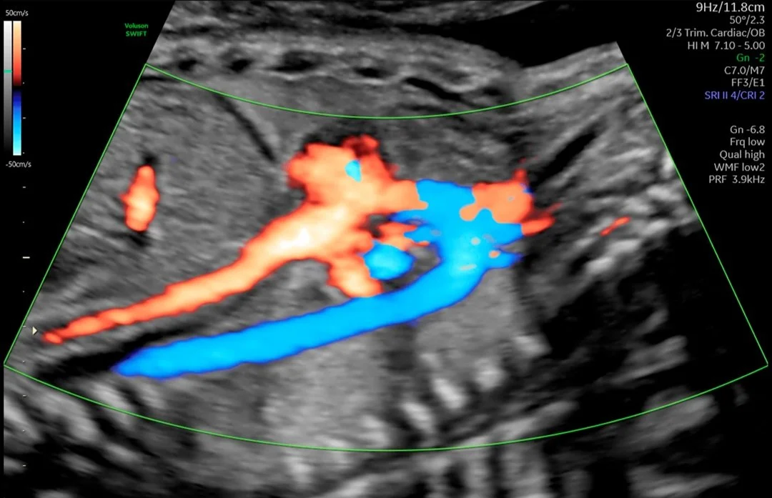 Arco aórtico con HD-Flow™.jpg