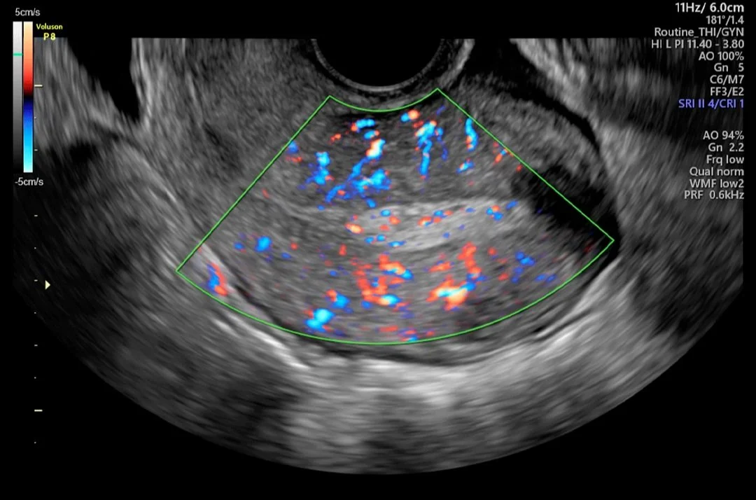 Útero con HD-Flow™.jpg