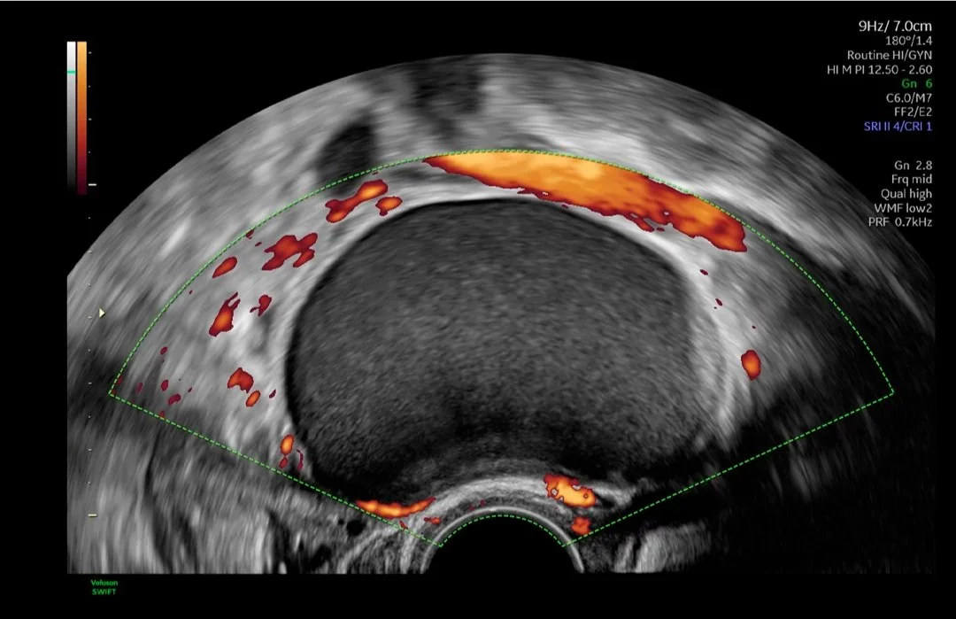 Endometrioma con Power Doppler.jpg
