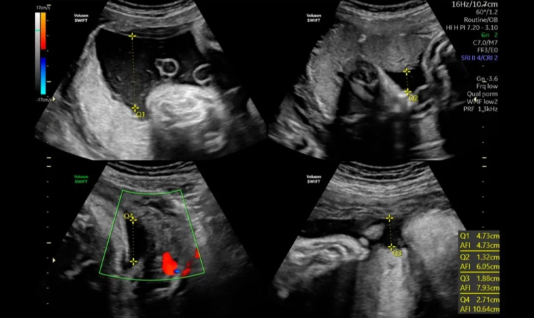 Evaluación del volumen del líquido amniótico.jpg