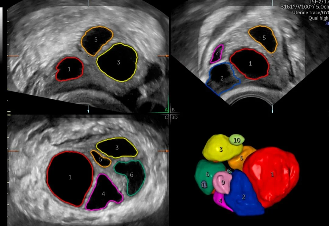 Folículo con️SonoAVC™.jpg