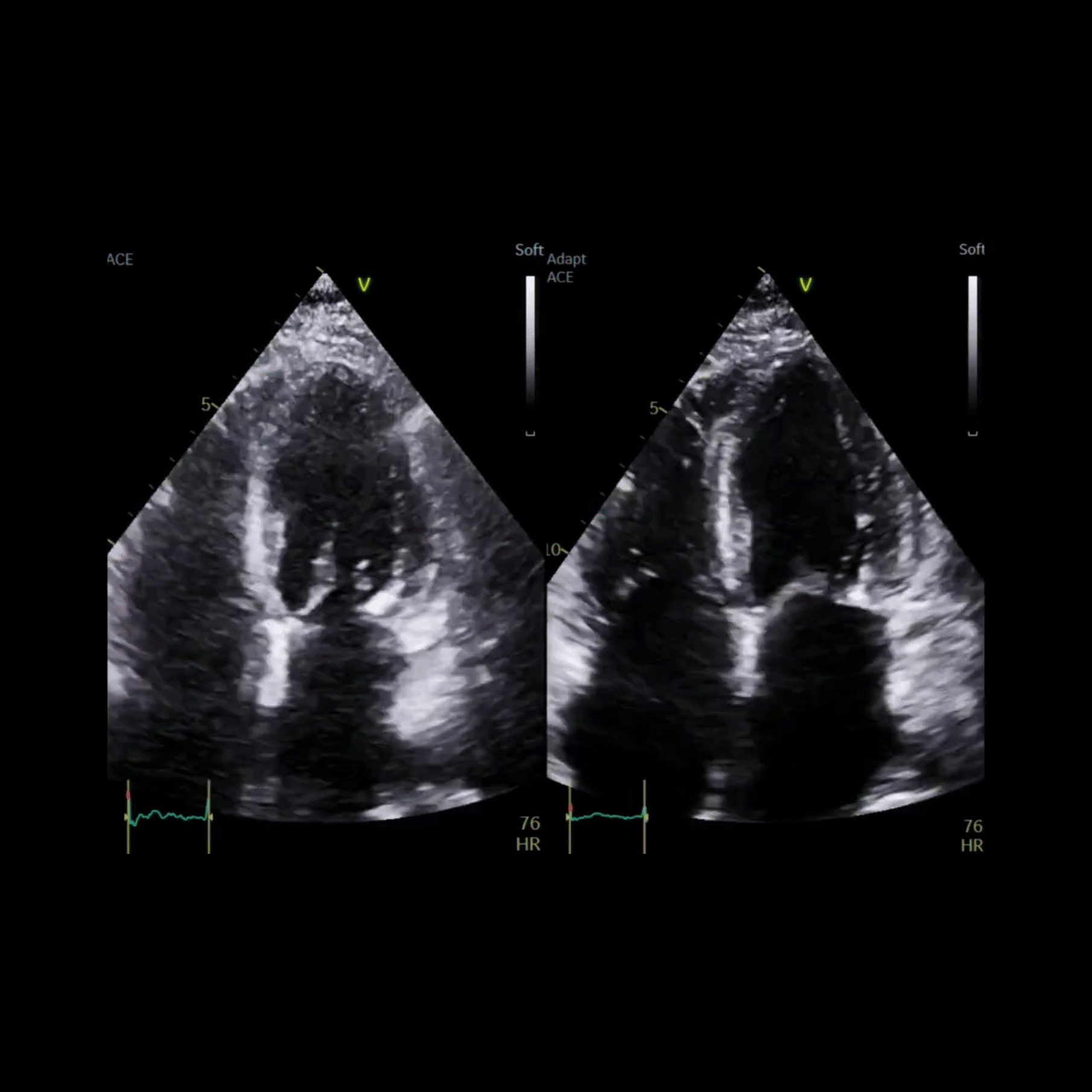 Vivid E Series Ultrasound Systems GE HealthCare.gif