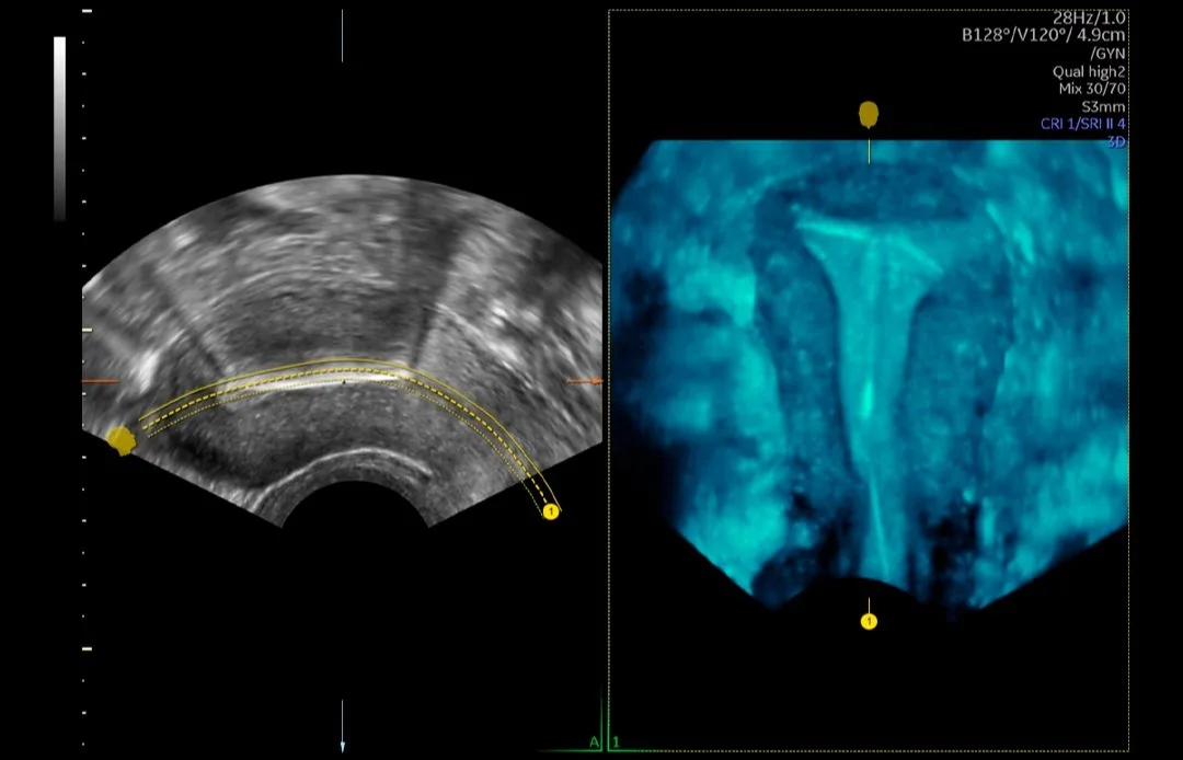 Uterine Trace- DIU.jpg
