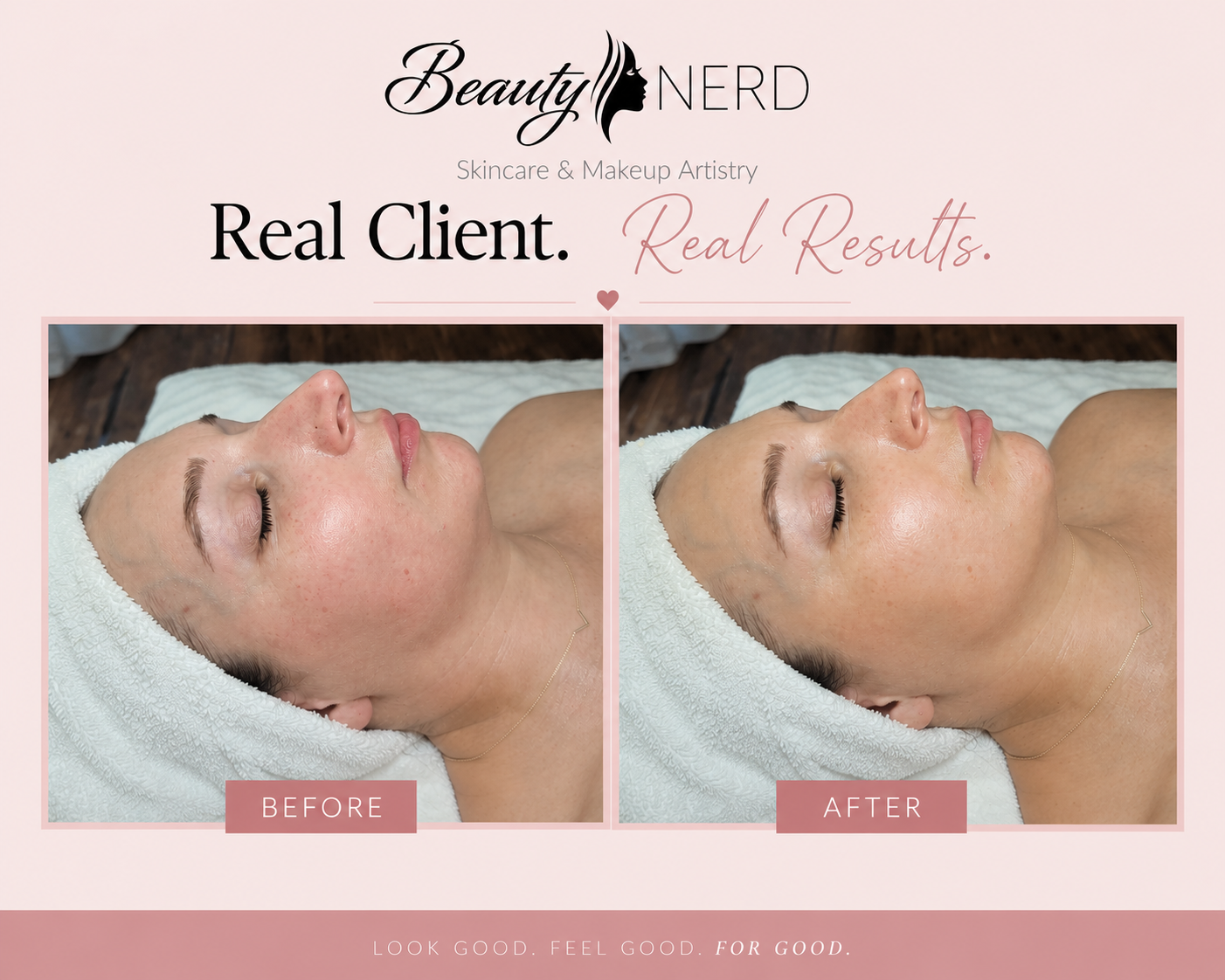 Comparison of a woman's face before and after skincare treatment, with the woman lying on a towel, demonstrating reduced redness and smoother skin in the after image.