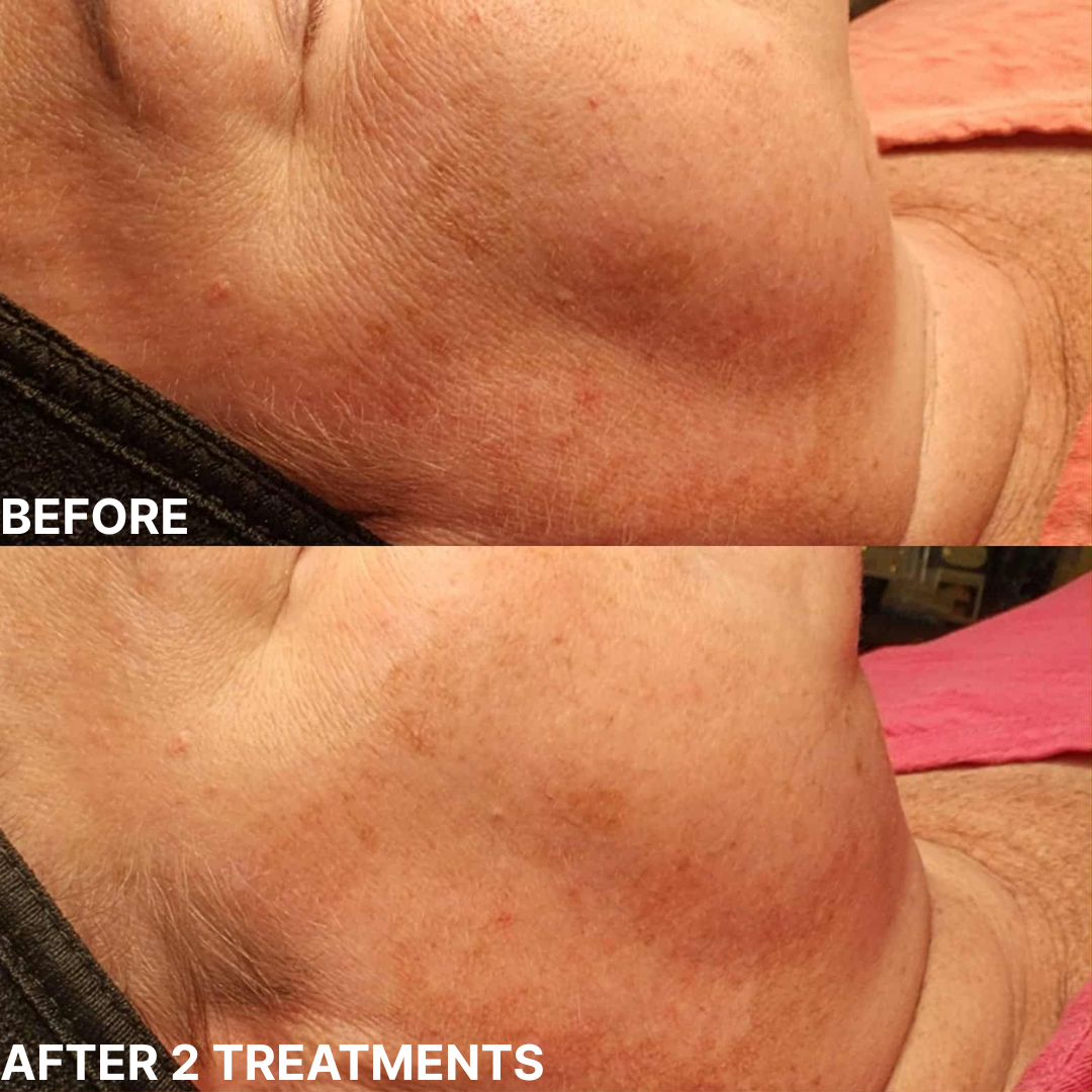 Mela Pro Plus Cold Peel