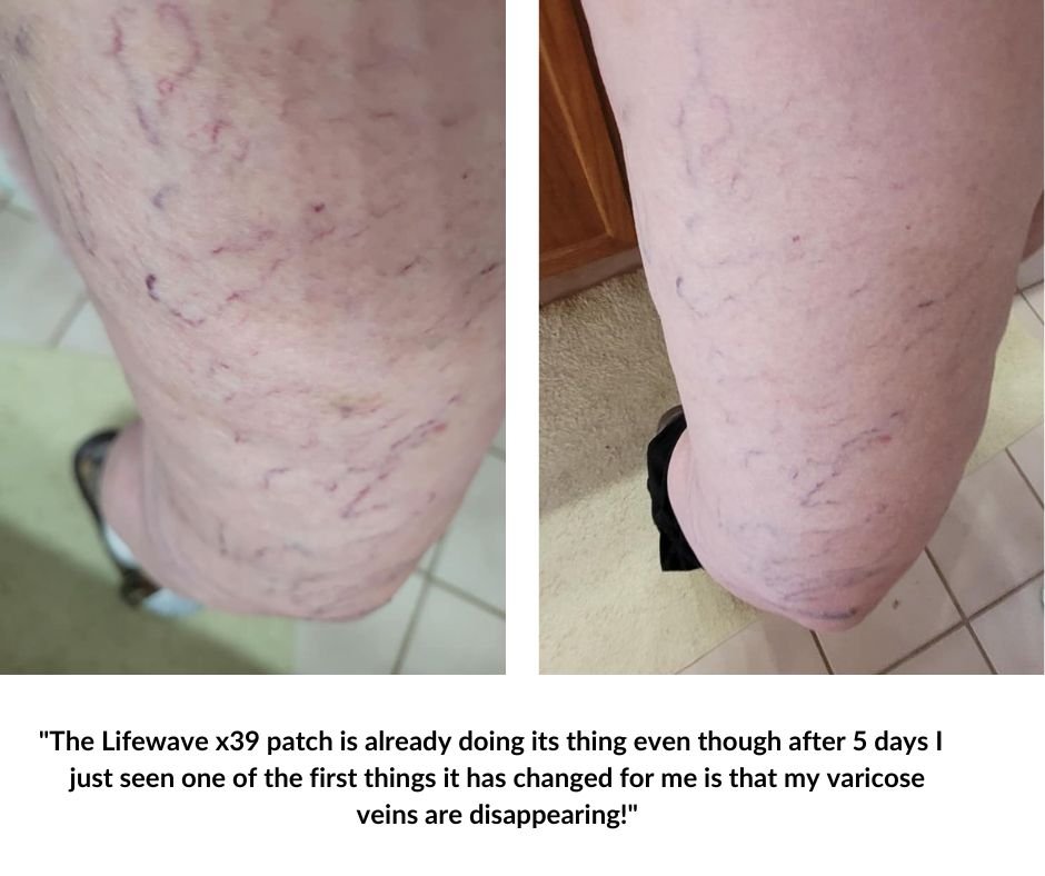The Lifewave x39 patch is already doing its thing even though after 5 days I just seen one of the first things it has changed for me is that my varicose veins are disappearing!.jpg