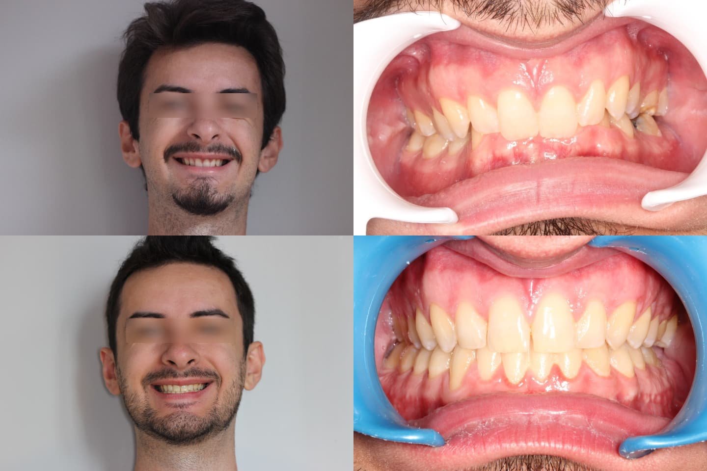 TRAITEMENT RÉALISÉ PAR MULTI-ATTACHES & CHIRURGIE ORTHOGNATHIQUE