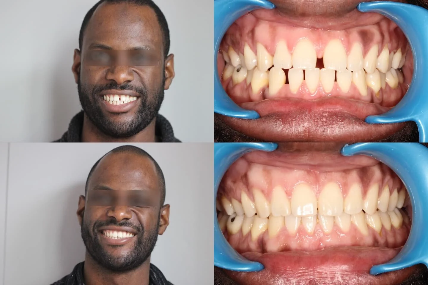 TRAITEMENT RÉALISÉ PAR MULTI-ATTACHES